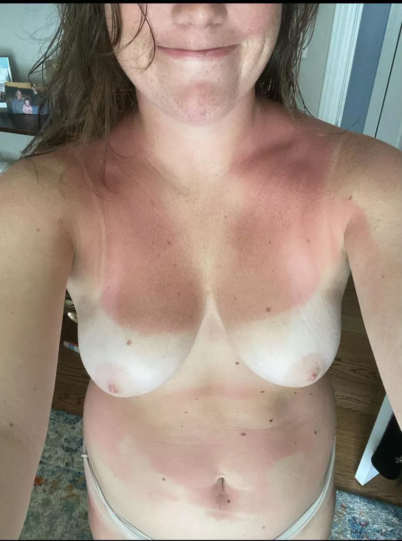 My friends gf accidentally sent me this pic of her sunburnt after beach. What do you think of her body?