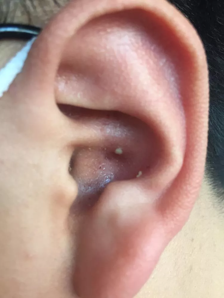 My lil bro’s ear pimple