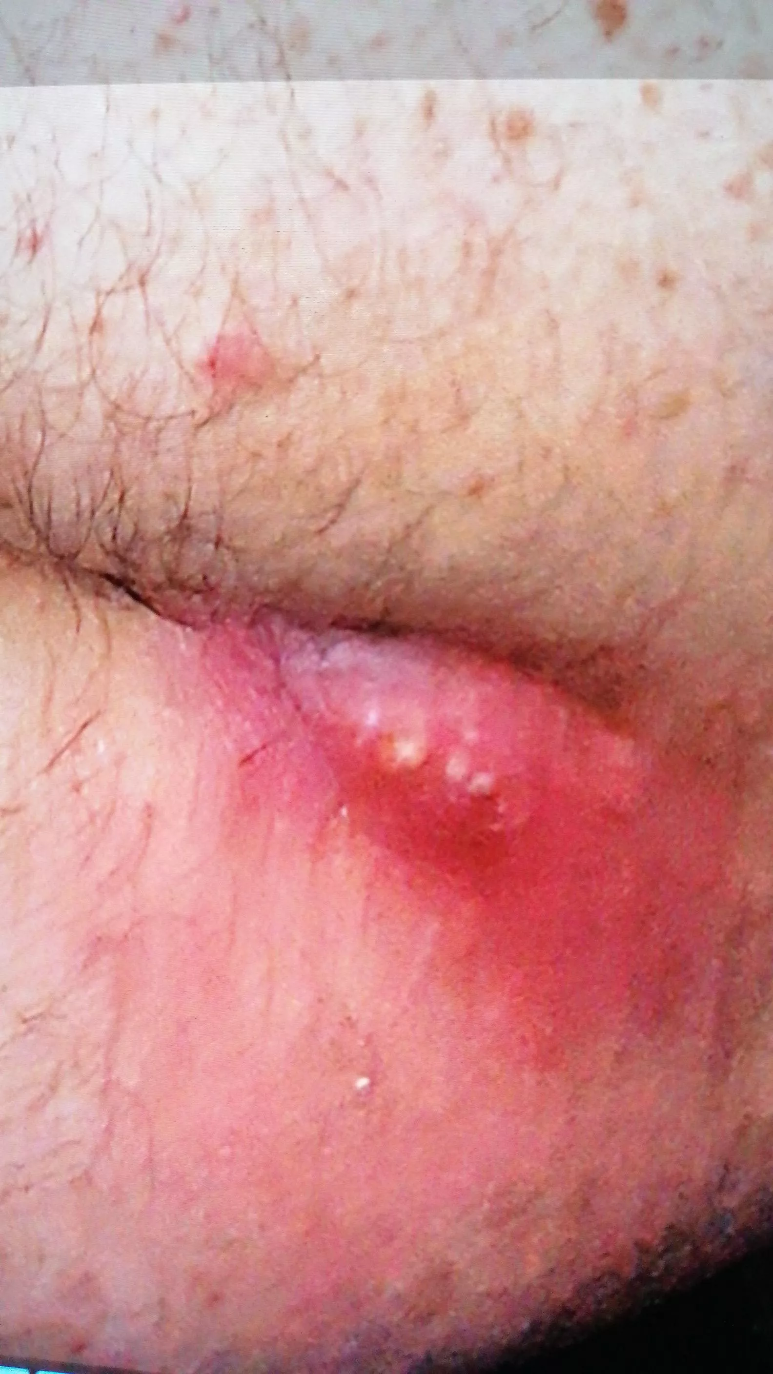 My pilonidal abscess before visiting Doc's. So painful.