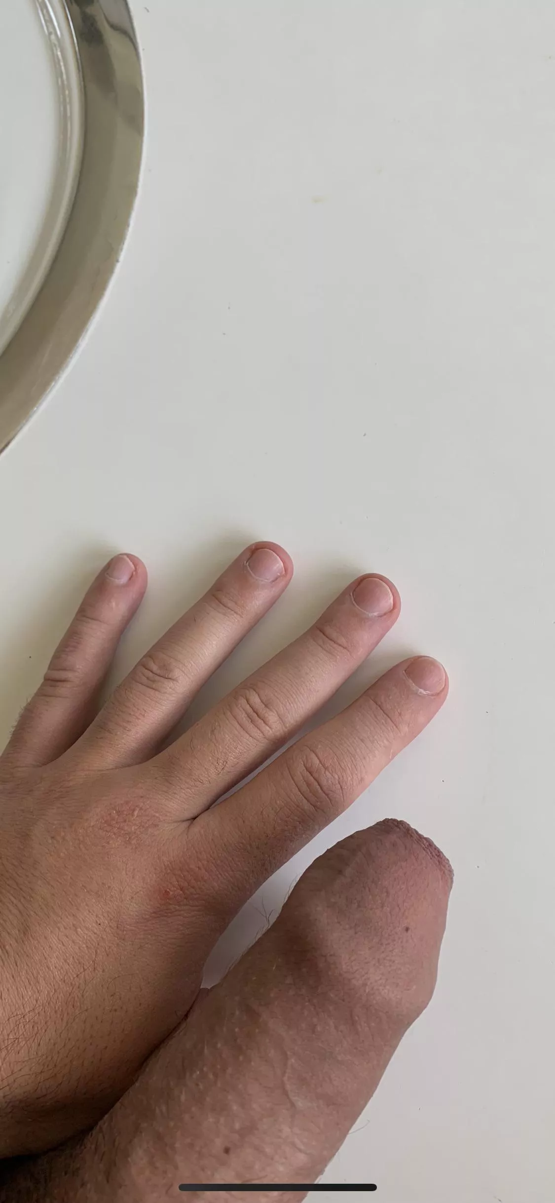 My thumb has gotten swollen (m)