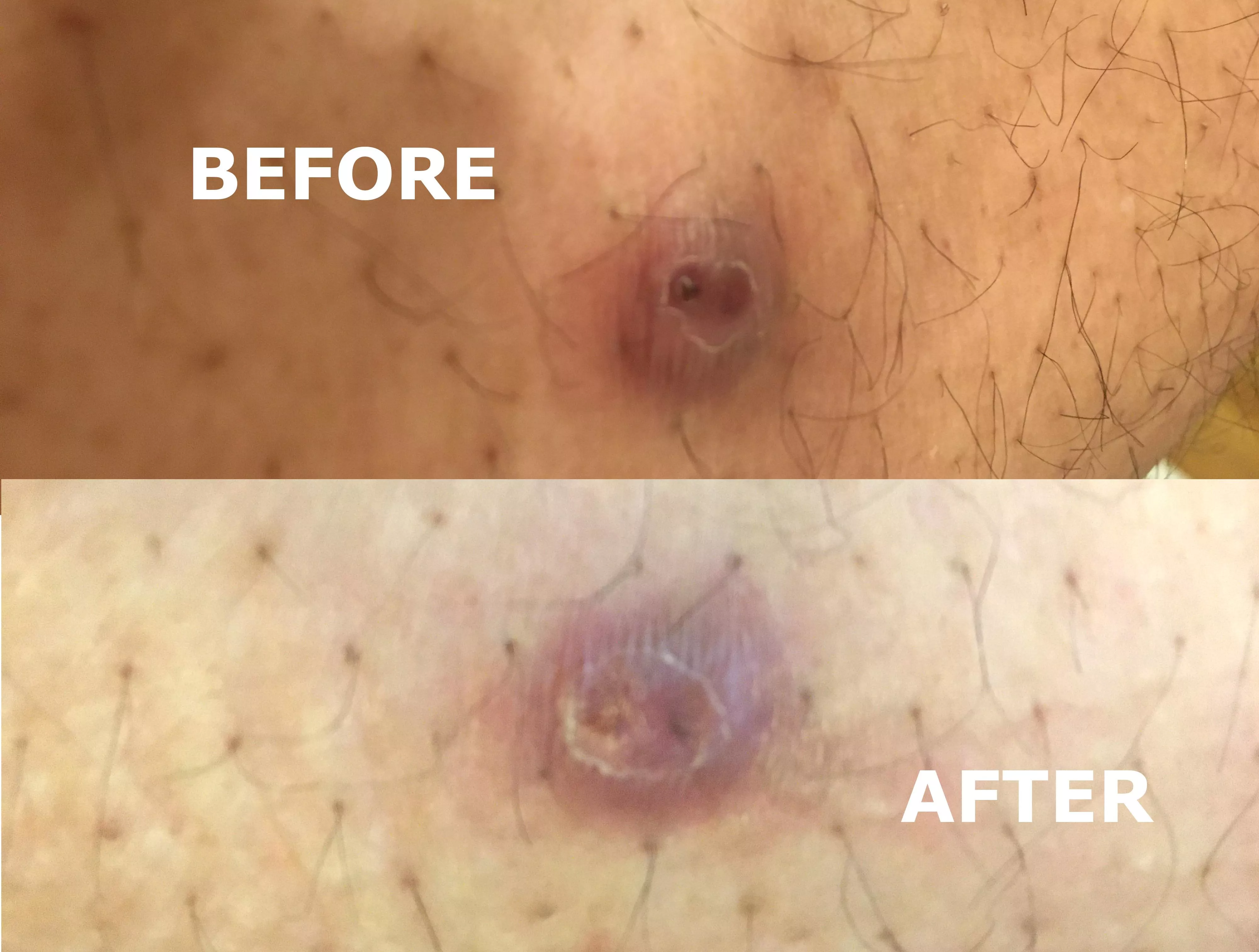 Not much difference (ingrown hair on belly?)