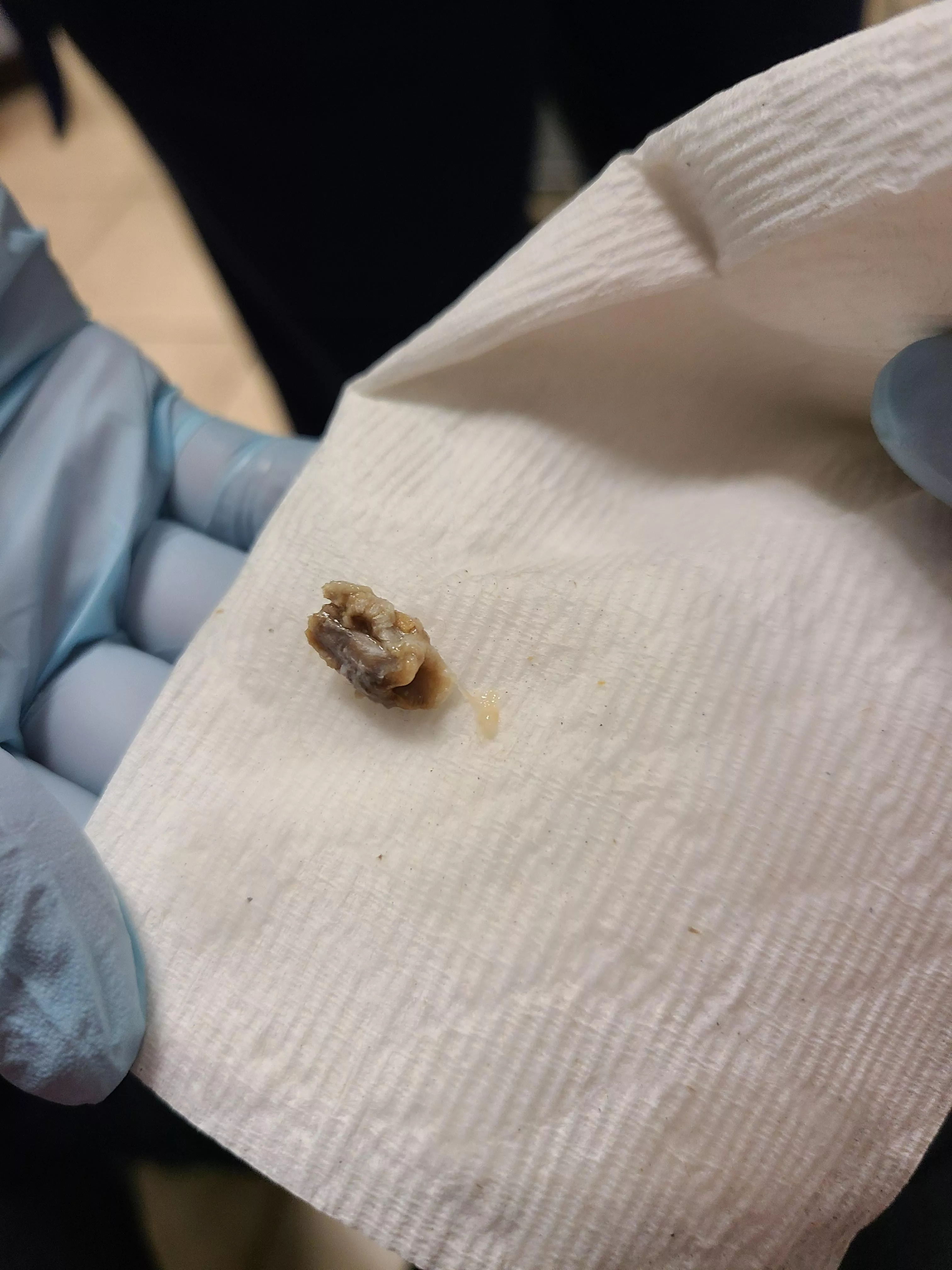 Not sure if this is the right place for this, but they pulled this out of my ear doing a lavage today.