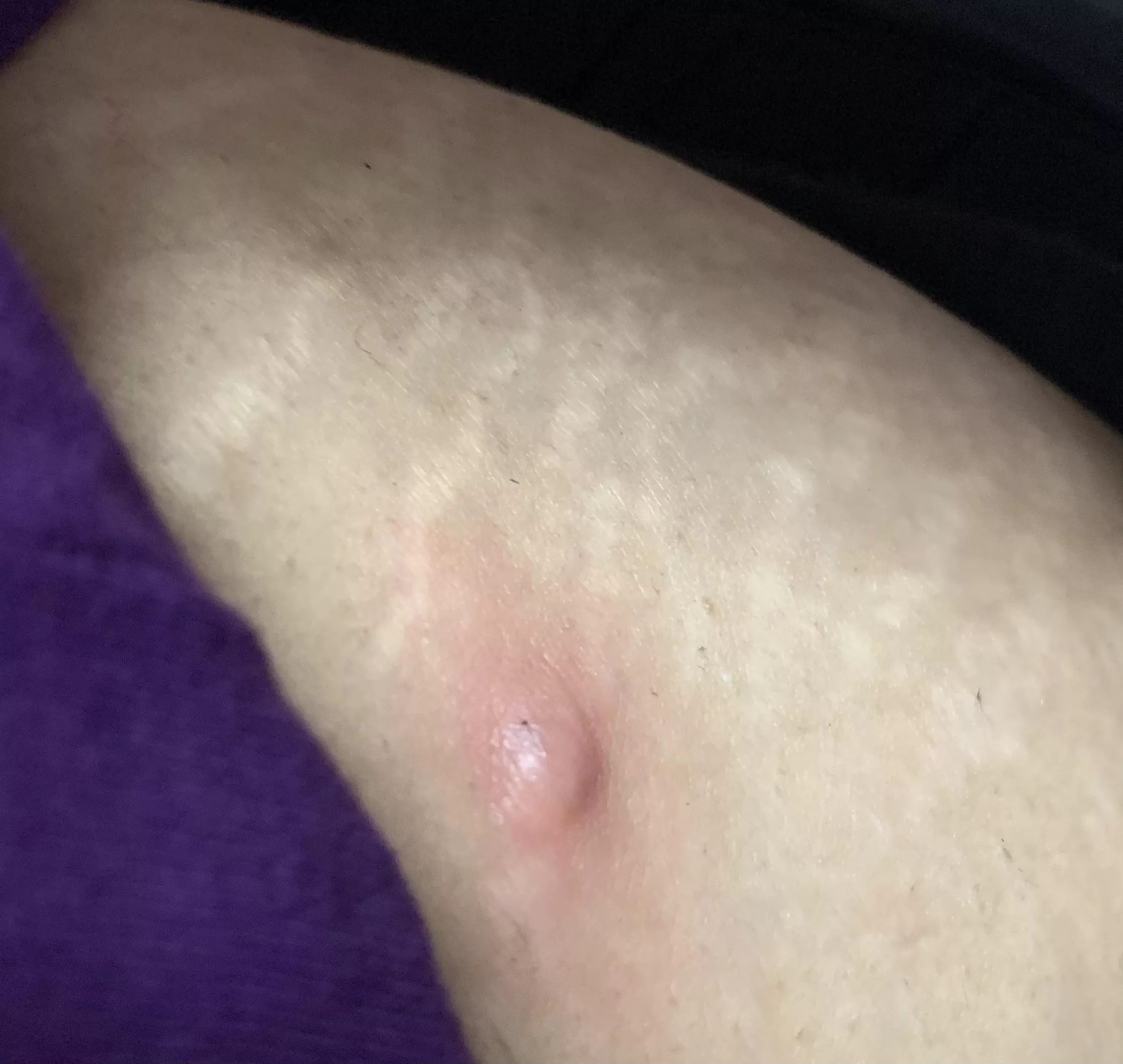 Noticed this weird looking thing on my hip today. Hurts when you press it. Donâ€™t know what it is.