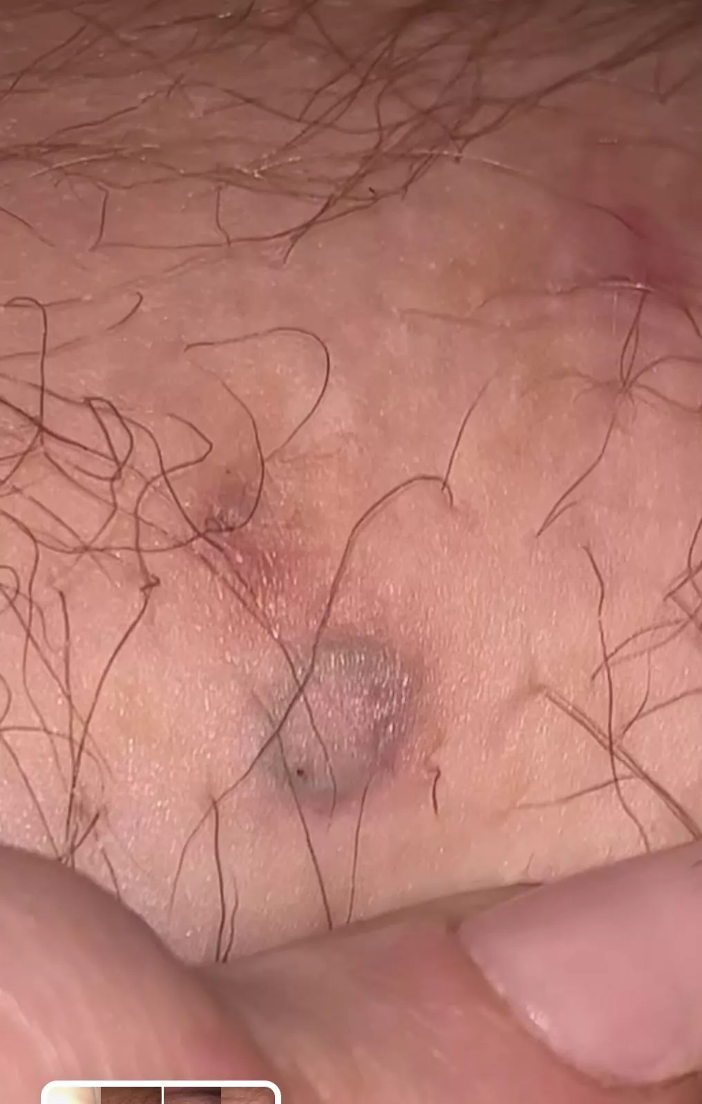 okay here’s the repost of my ingrown hair coil that i have yet to remove 🫠 (i’ll upload video when i actual do remove it)