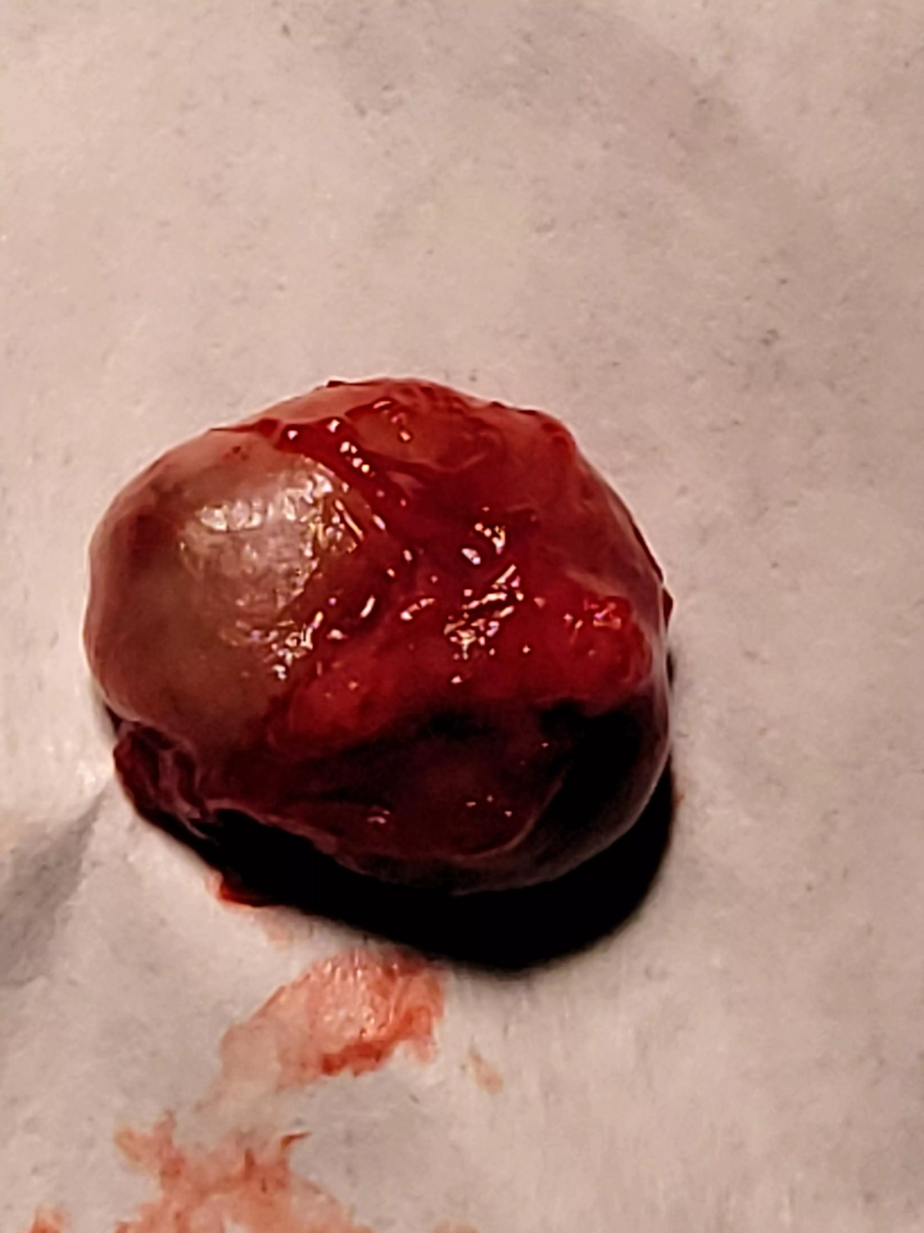 Pilar cyst fresh off my scalp today. Dr wouldn't let me record the procedure. Barely over 1cm