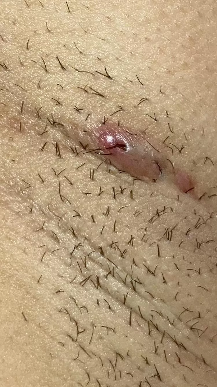 Pili multigemini and follicular cyst?