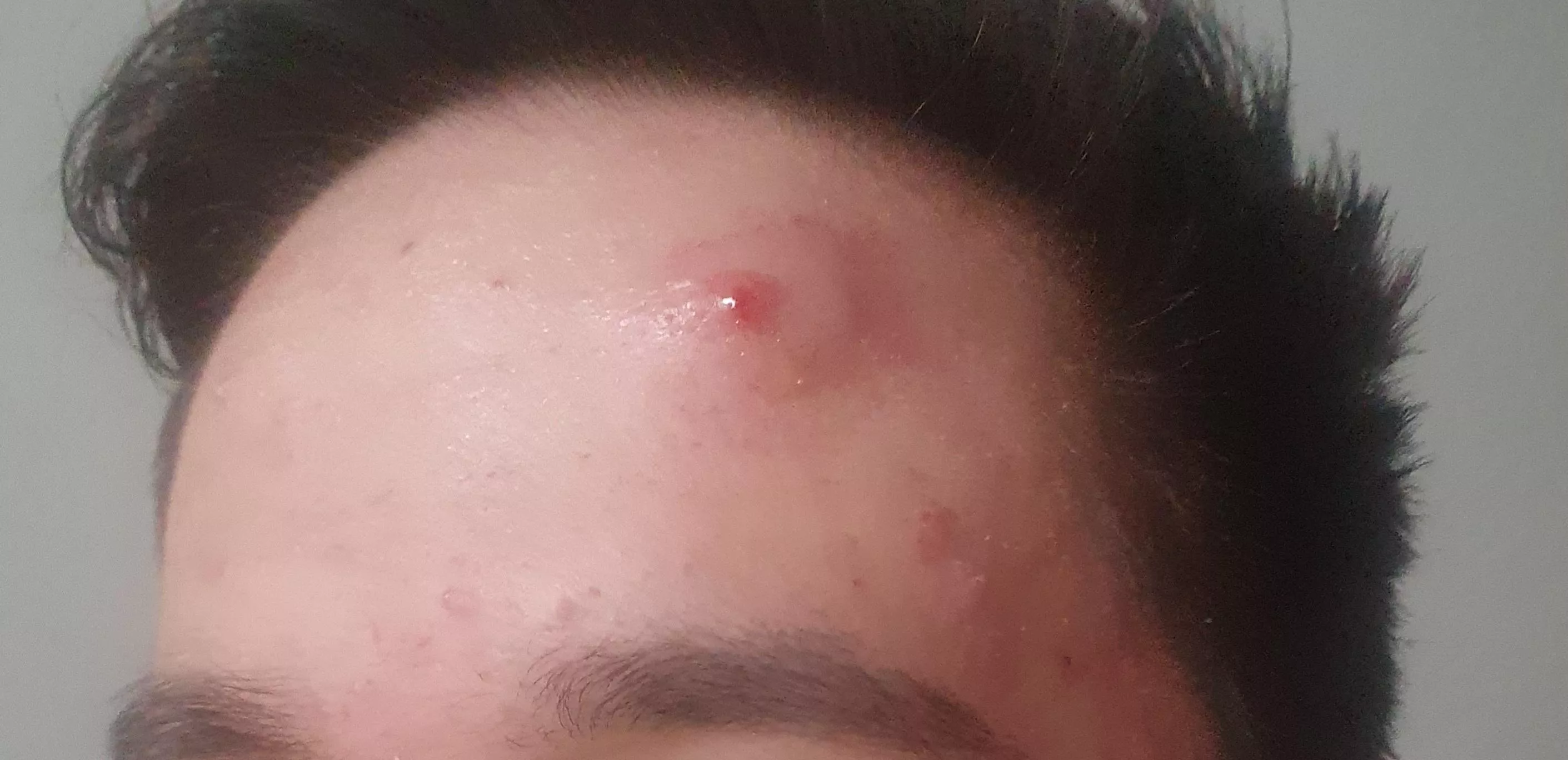 Popped a big pimple and now theres a huge bump around it, any advice and answers what to do?