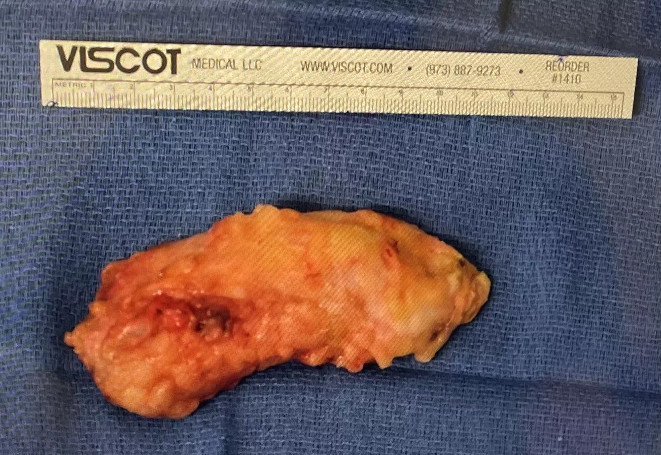 Right breast cyst (diagnosed as fat necrosis)