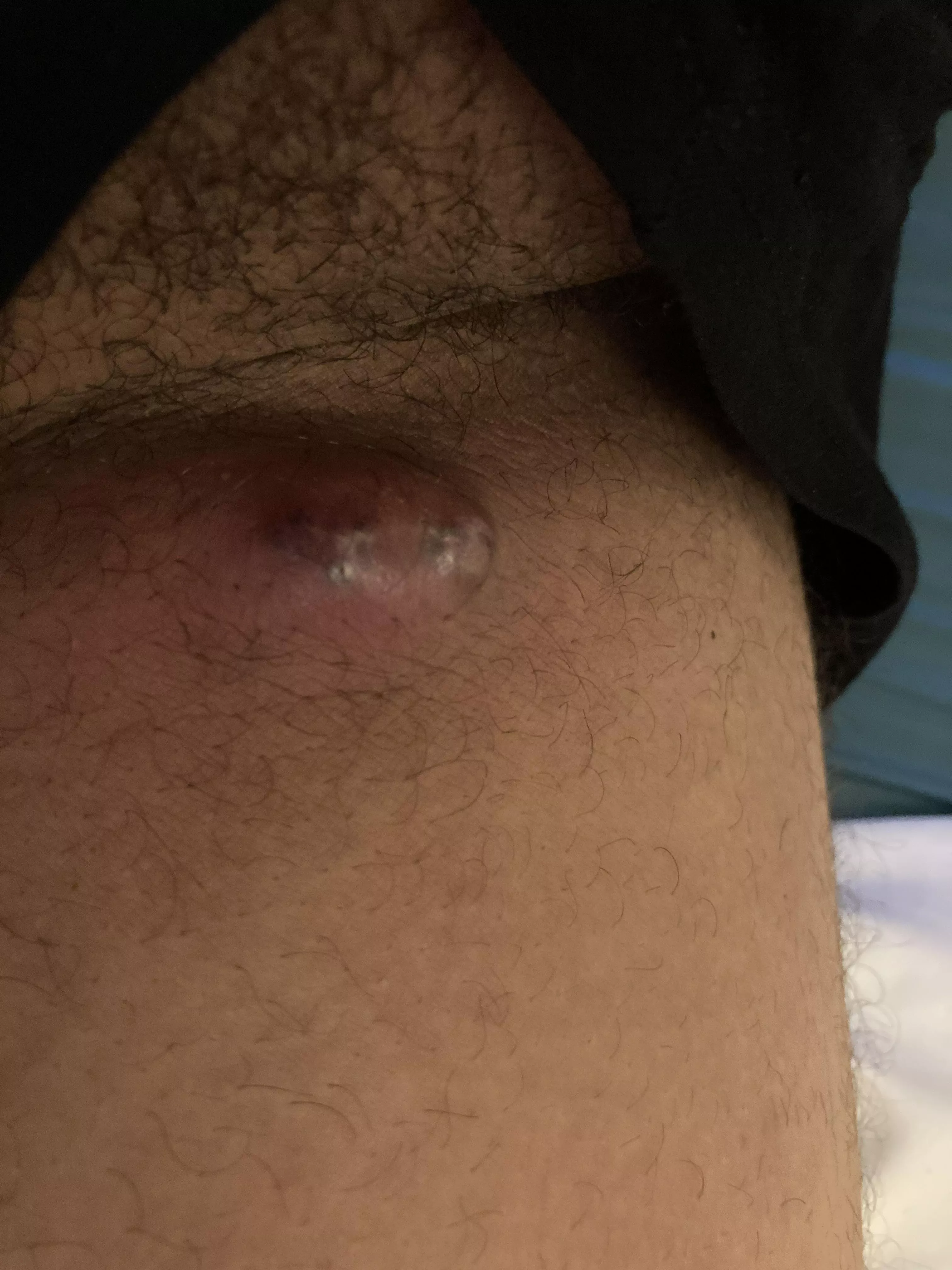 Should I be afraid of popping it at home? Inner thigh near crotch