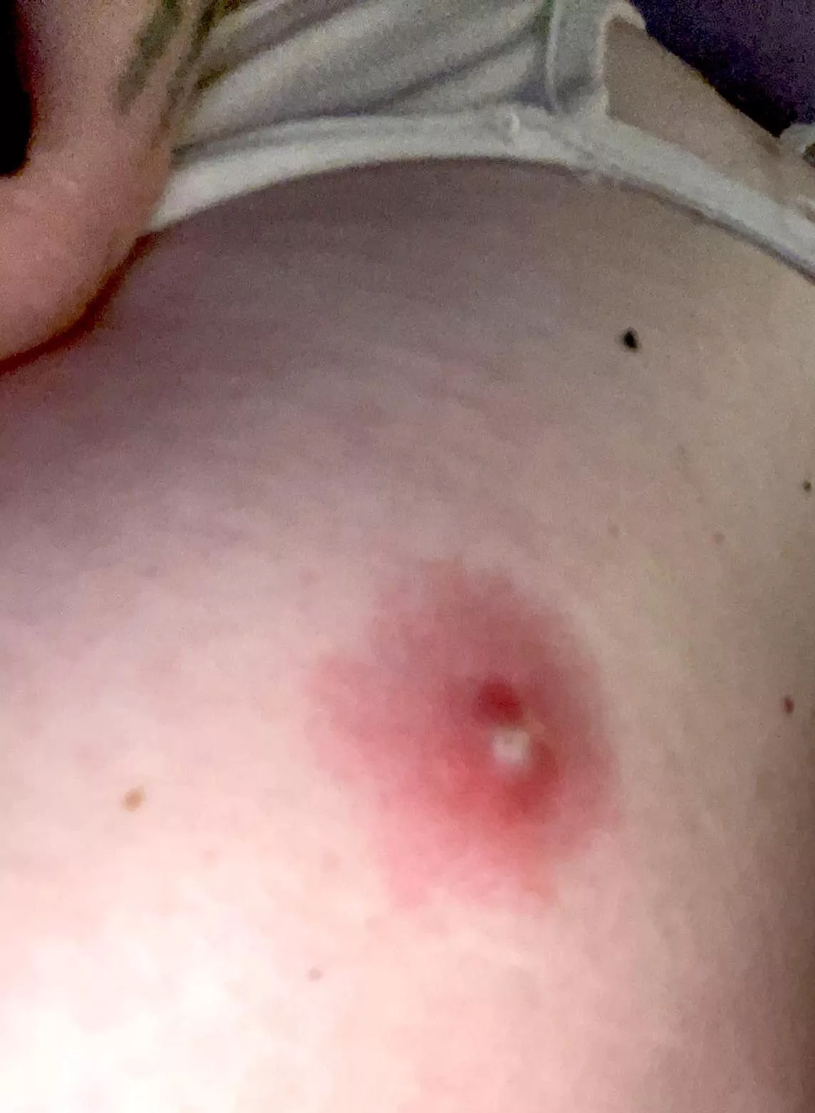 Should I pop this? Itâ€™s on my chest???