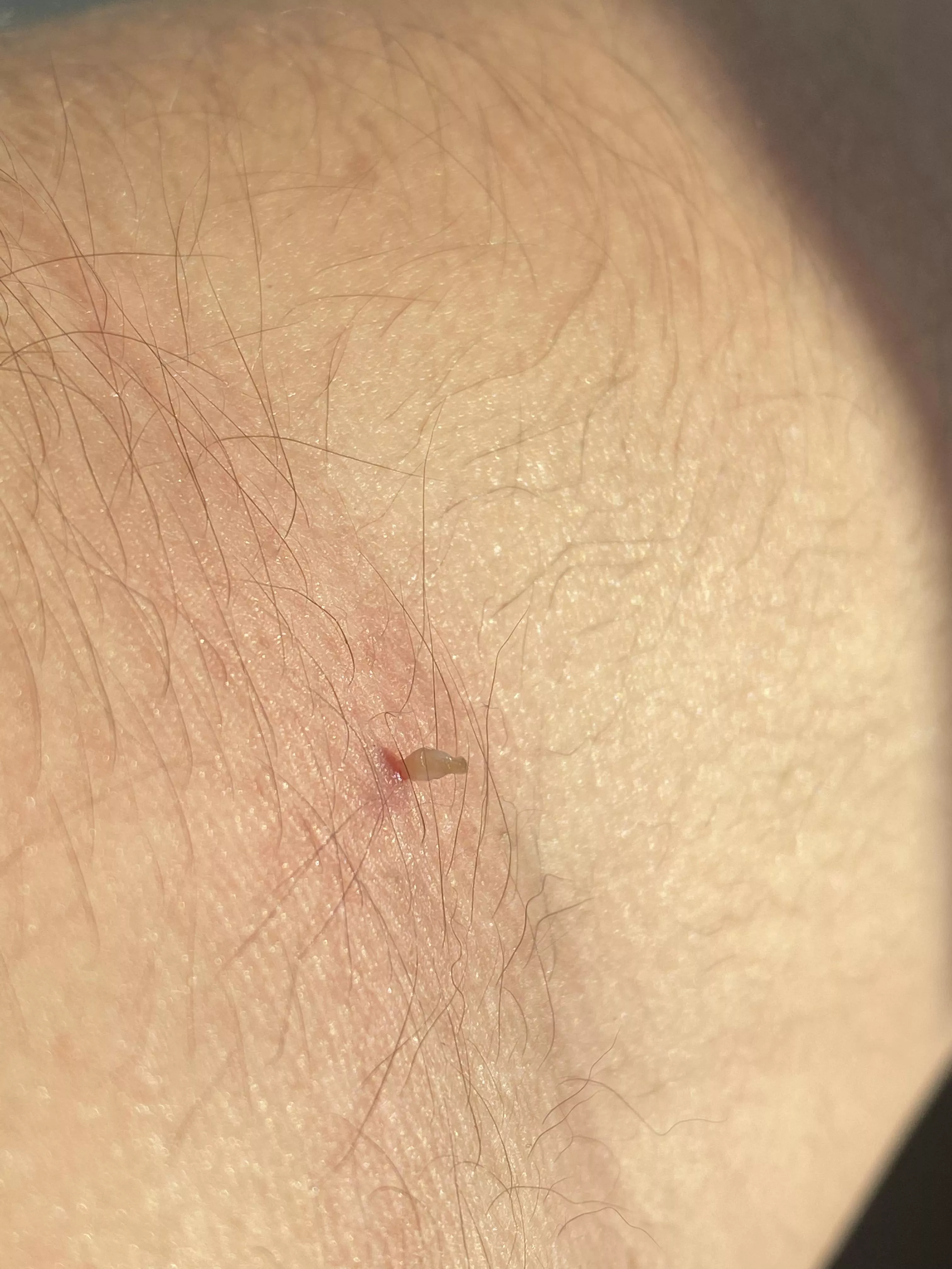 Small blackhead on arm :) I popped yesterday