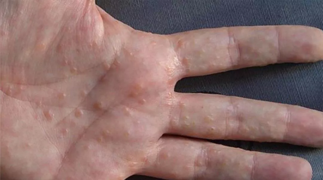 Some Dyshidrotic Eczema I had on my hands last year (both hands were covered like that, took over a month to clear up)