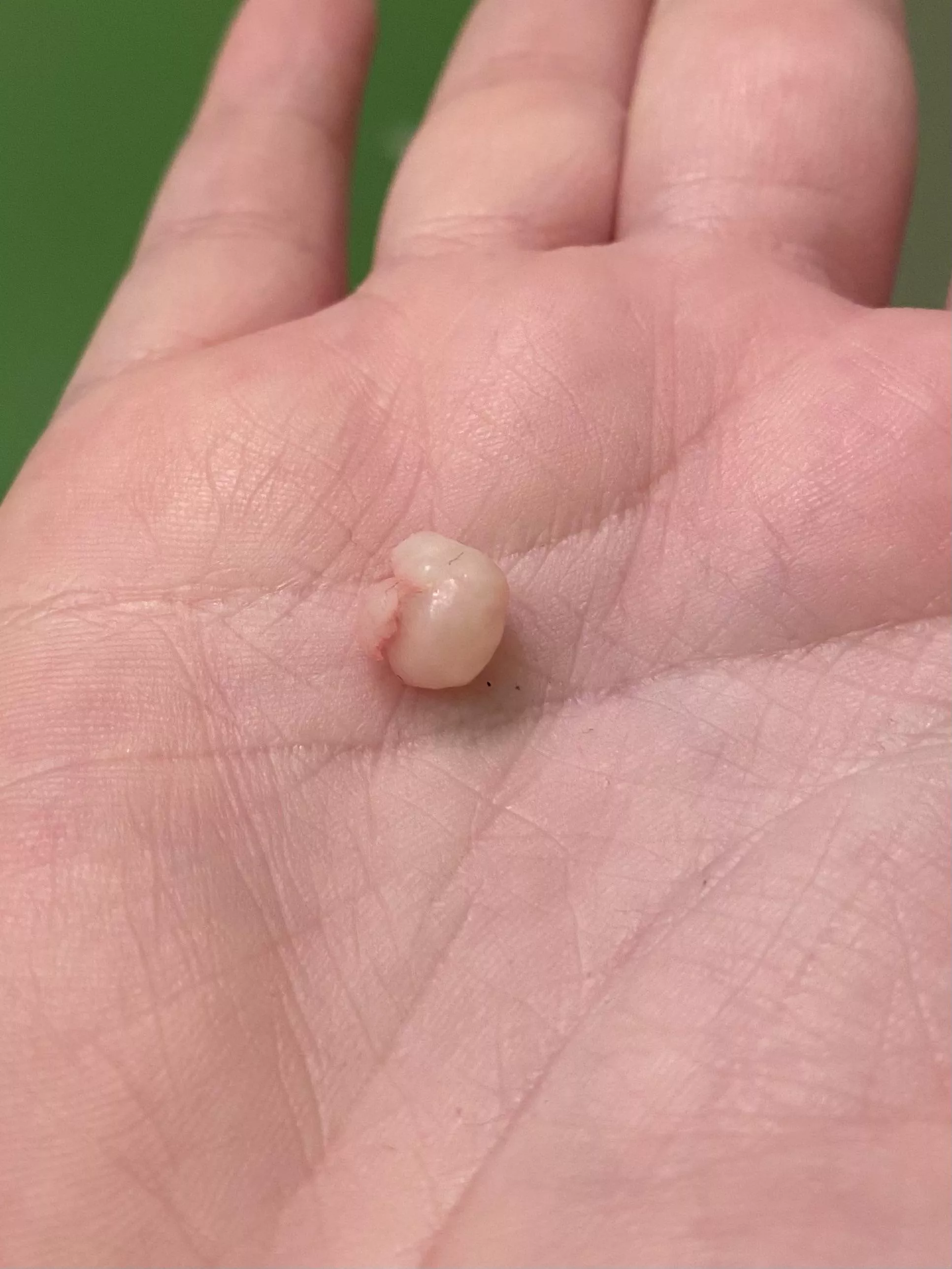 The latest cyst I excised today. This is the 2nd one. The first one had 3 in it.