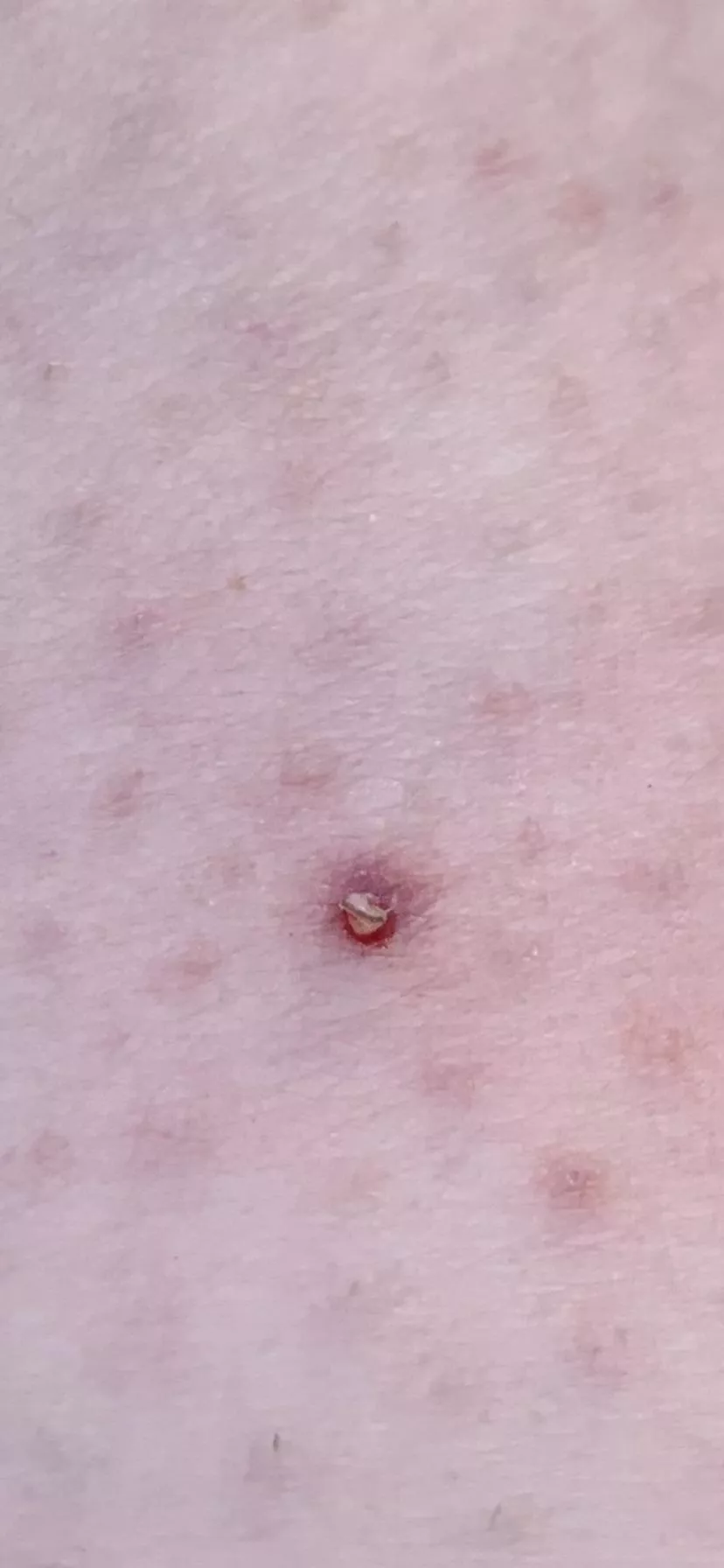 Thigh , ingrown hair. Close up.