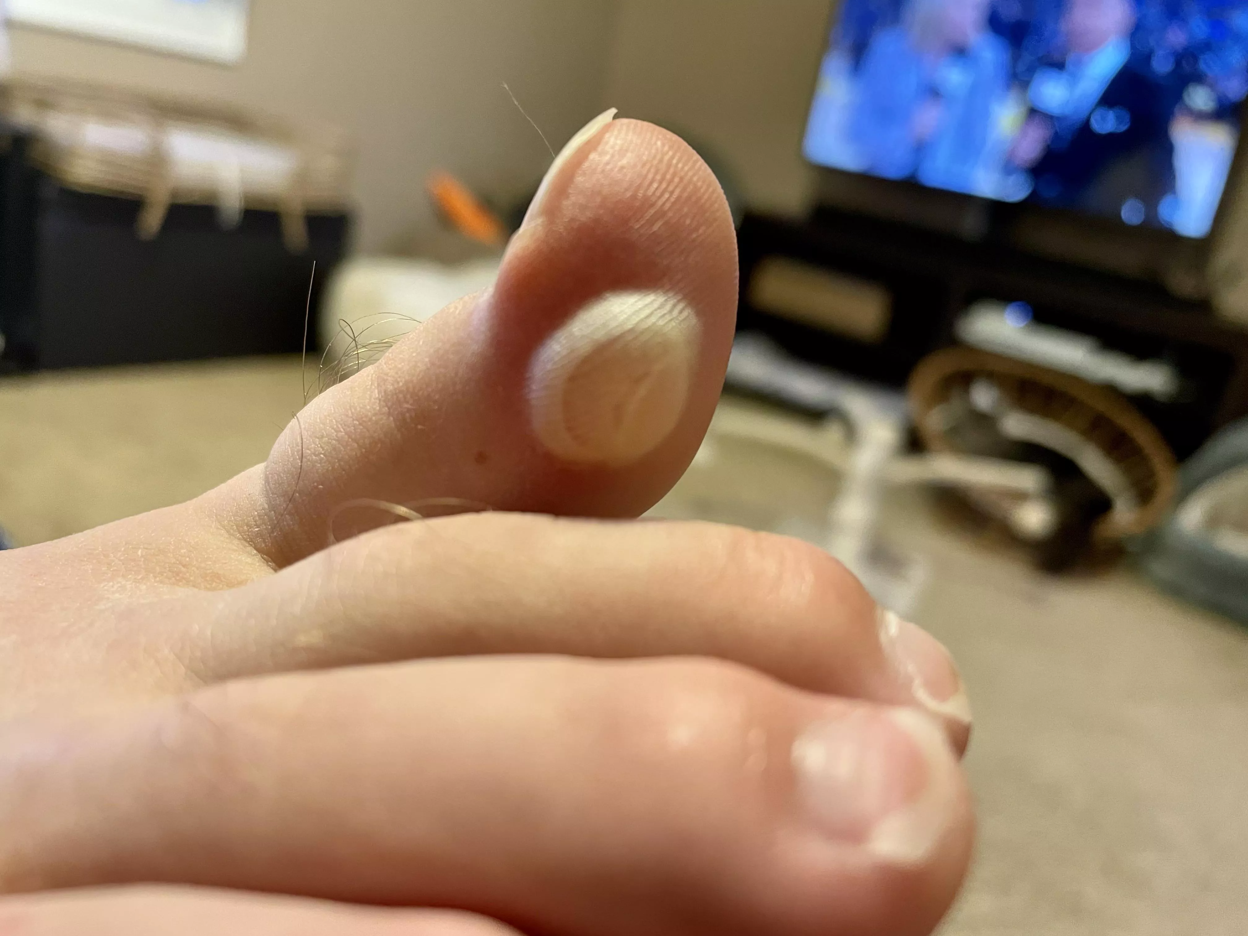 This forbidden one has been growing on my husbands big toe each time he plays basketball