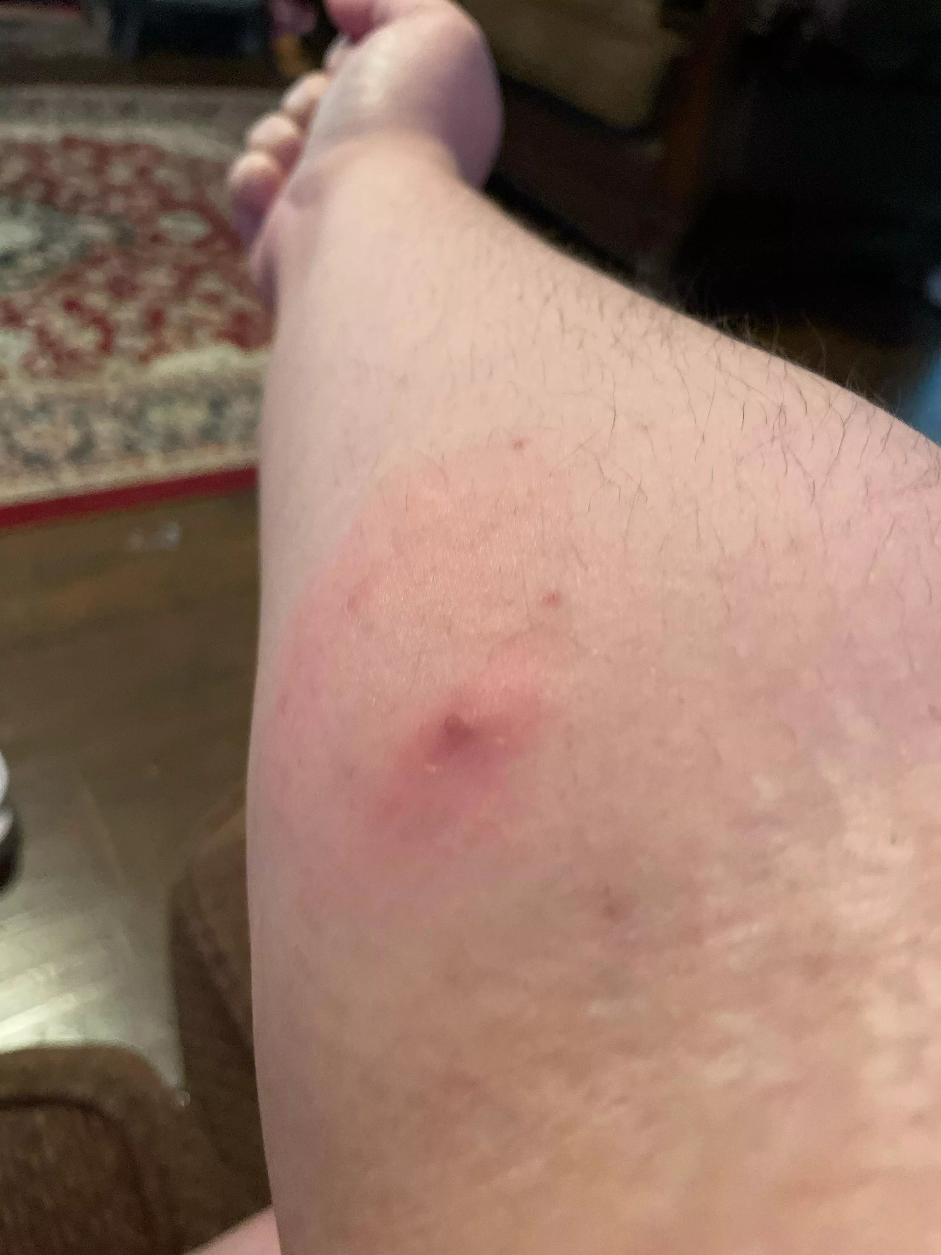 This forbidden pop showed up yesterday and it hurts when I curl my arm