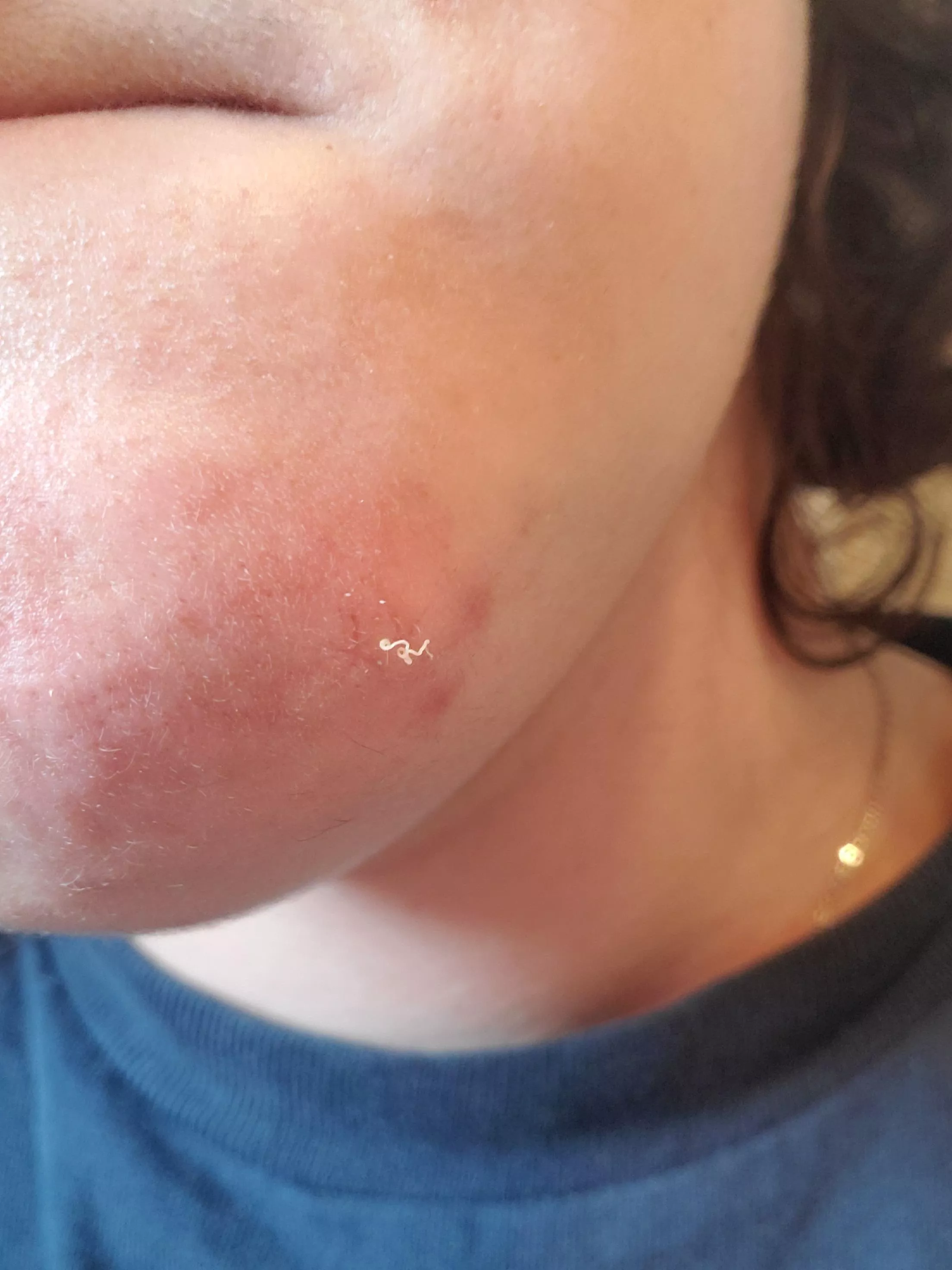 This little squiggly guy on my chin