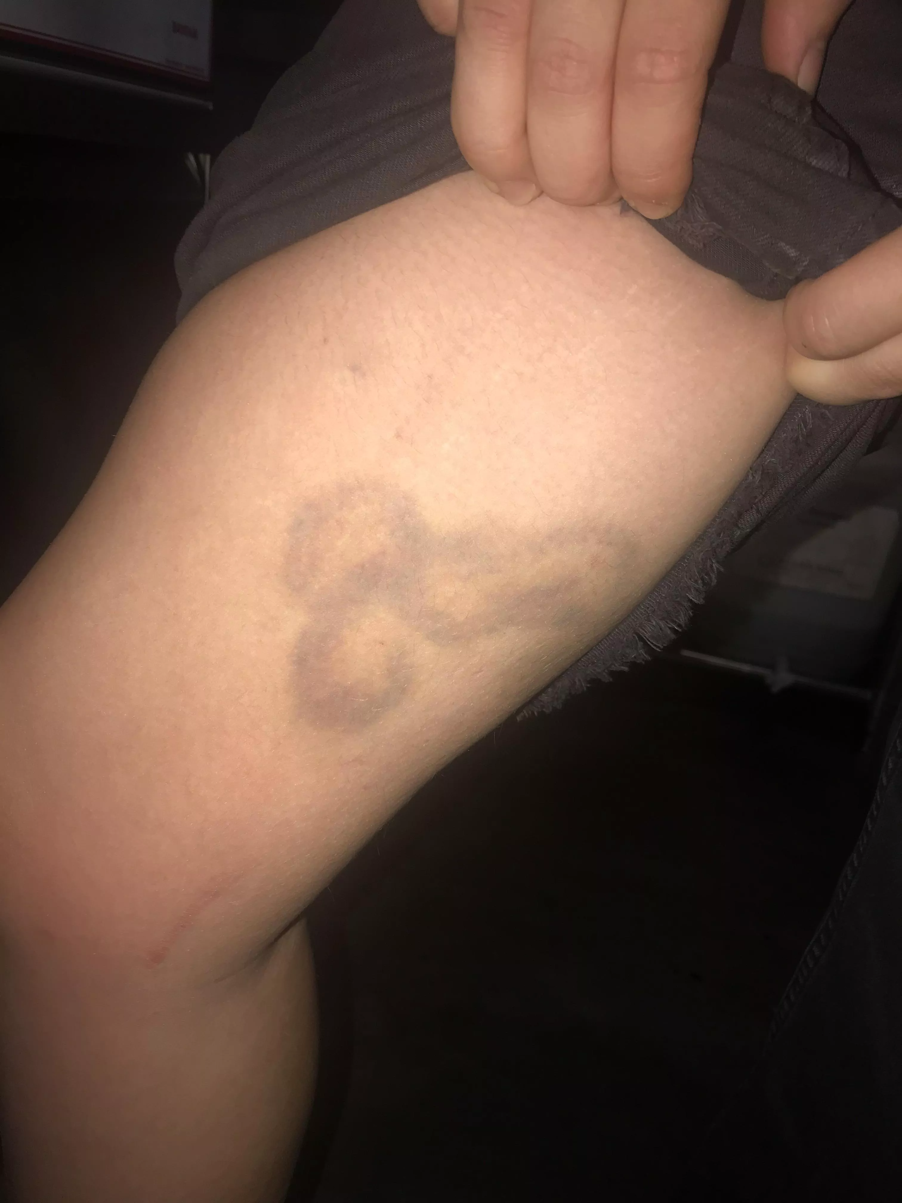 This NSFW bruise on my workmate!