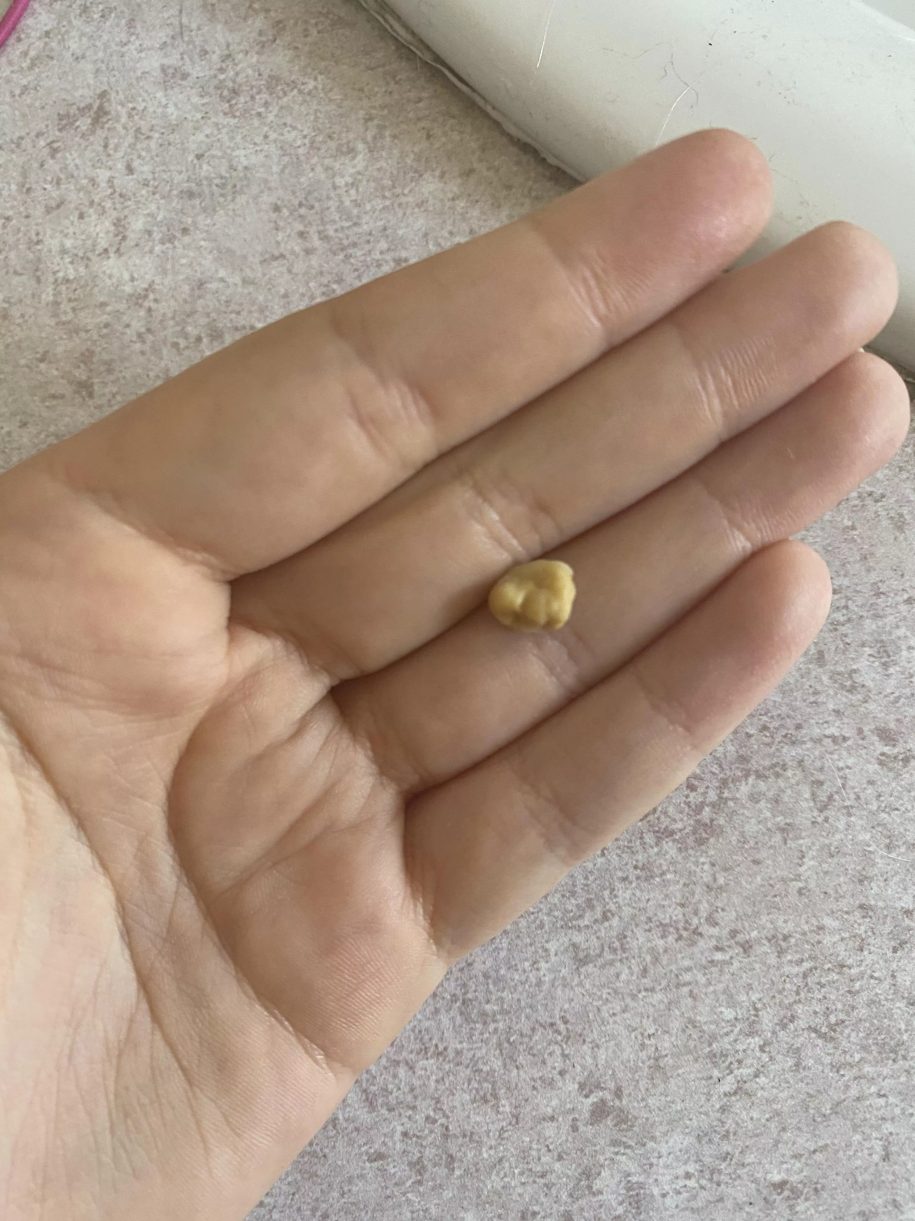 Tonsil stone removed