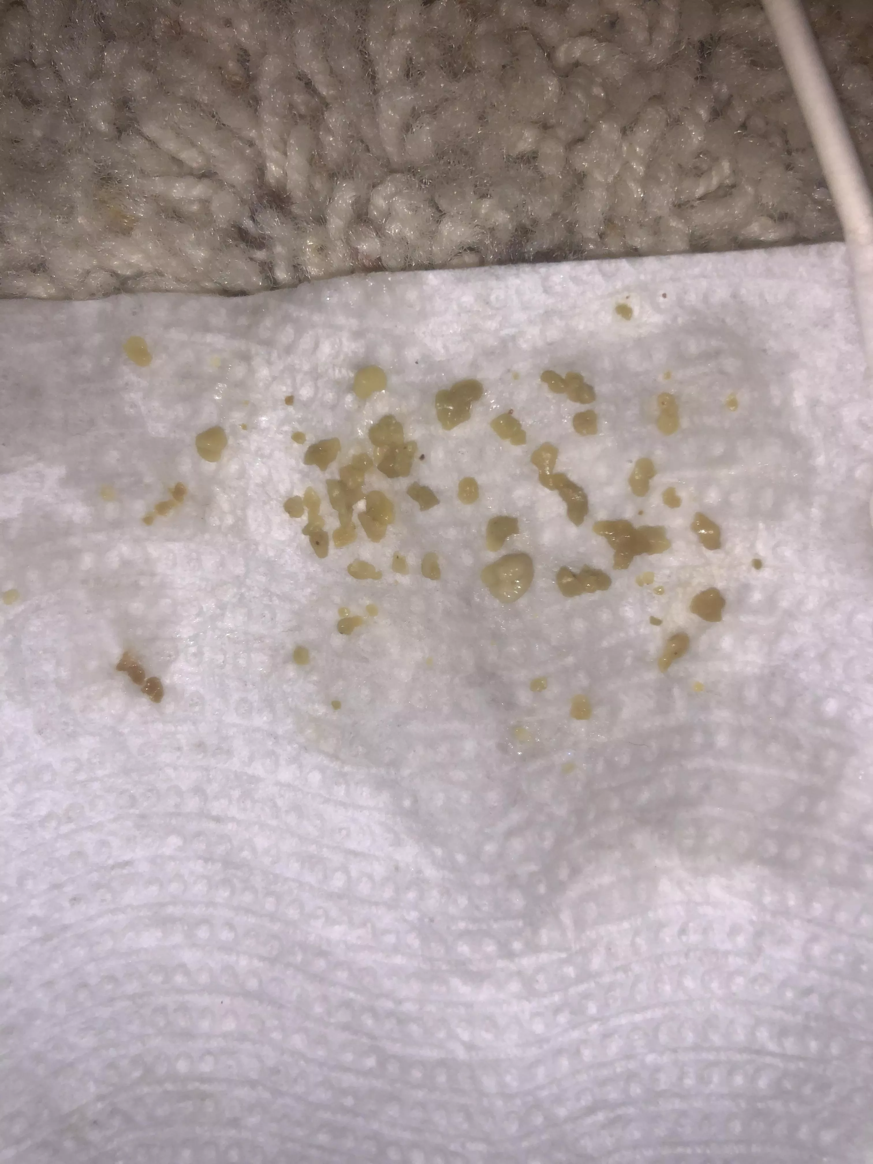 Tonsil stones — these all just came out of one of my tonsils just now, this isn’t even all of them, and they are still coming out. This is so much, is this normal? I’m grossed out