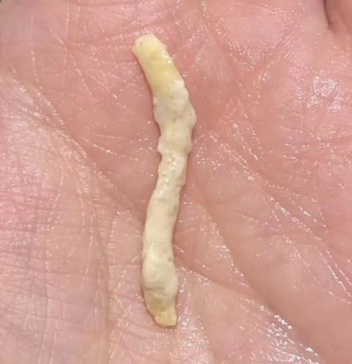 Unexpected Rubbery Noodle Blocking Tear Duct