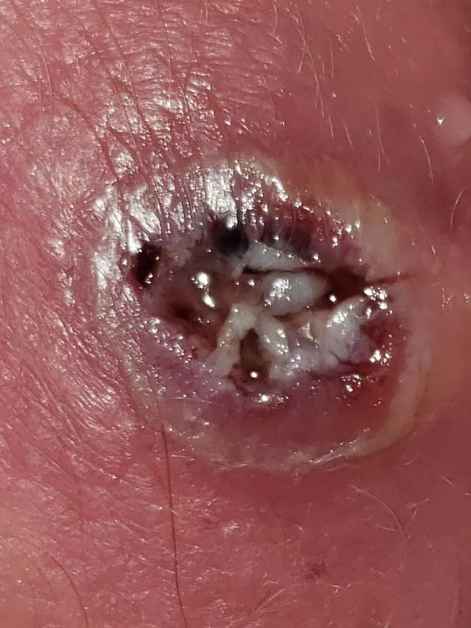 Update: My pilonidal cyst after draining and showering.