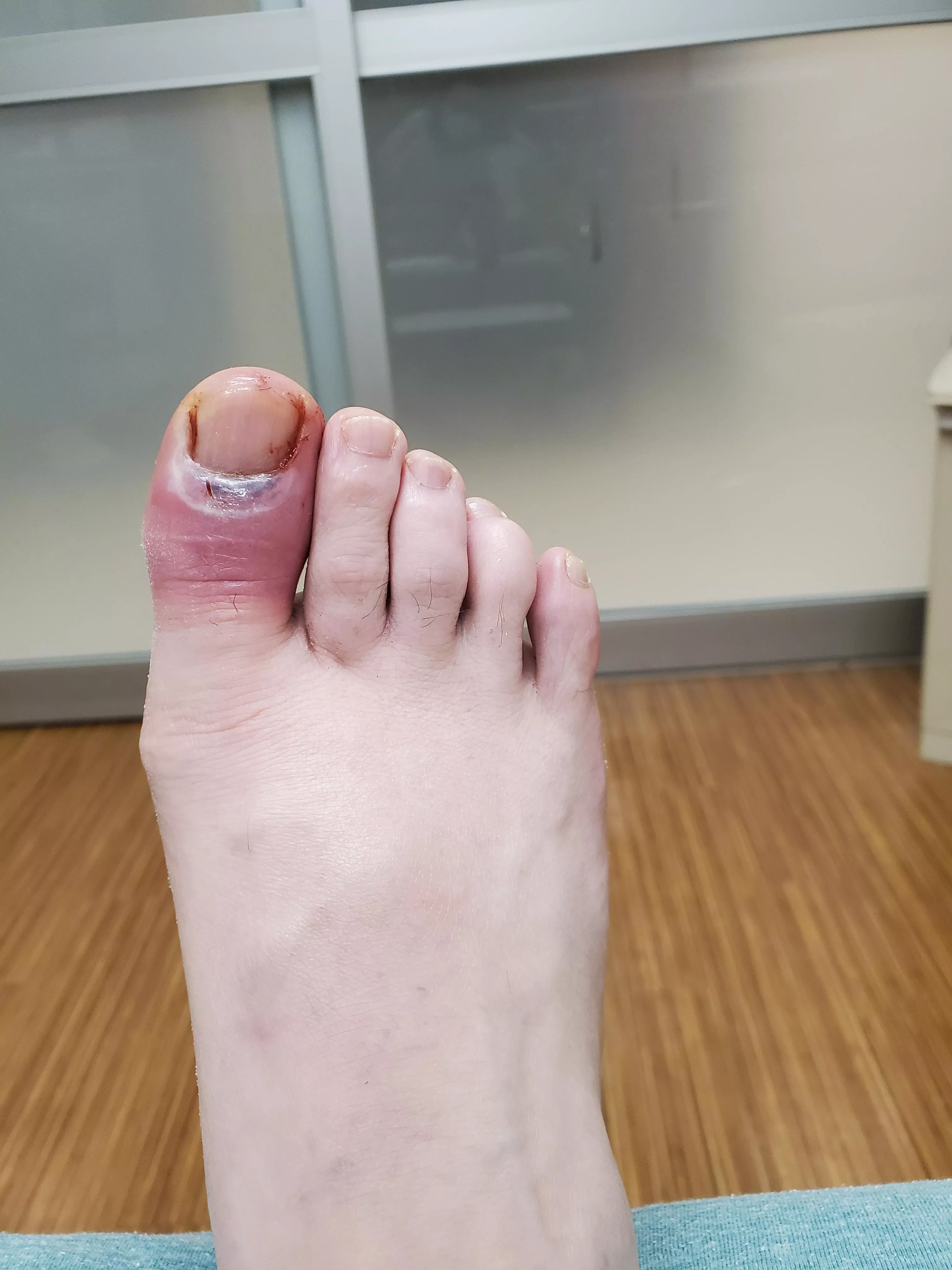 UPDATE: my toe should be okay! it looks worse, but that's normal. I'm on antibiotics for the next ten days. Thanks to everyone who told me to go in!