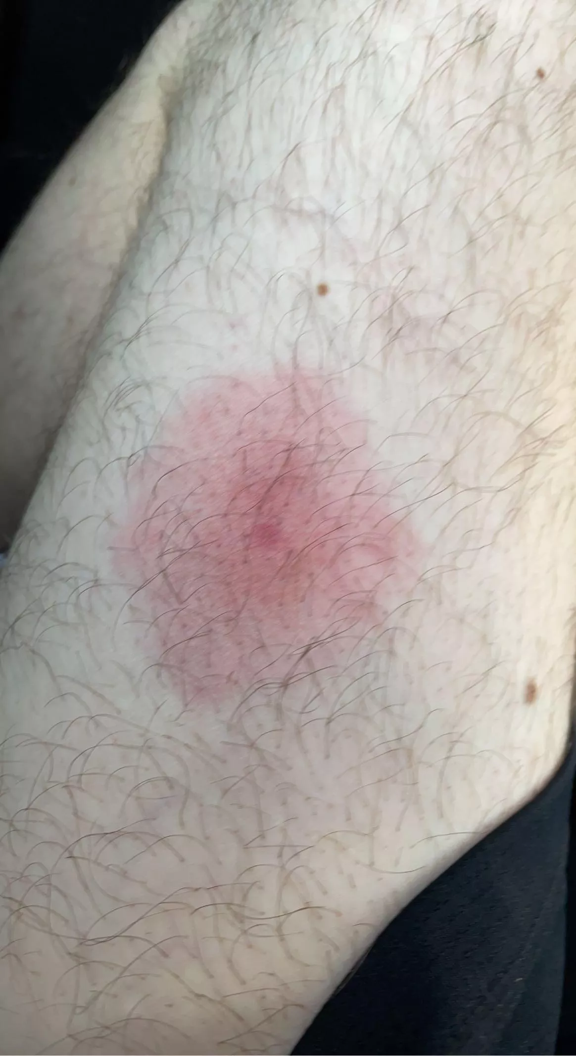 Went camping this weekend did a deer tick get me