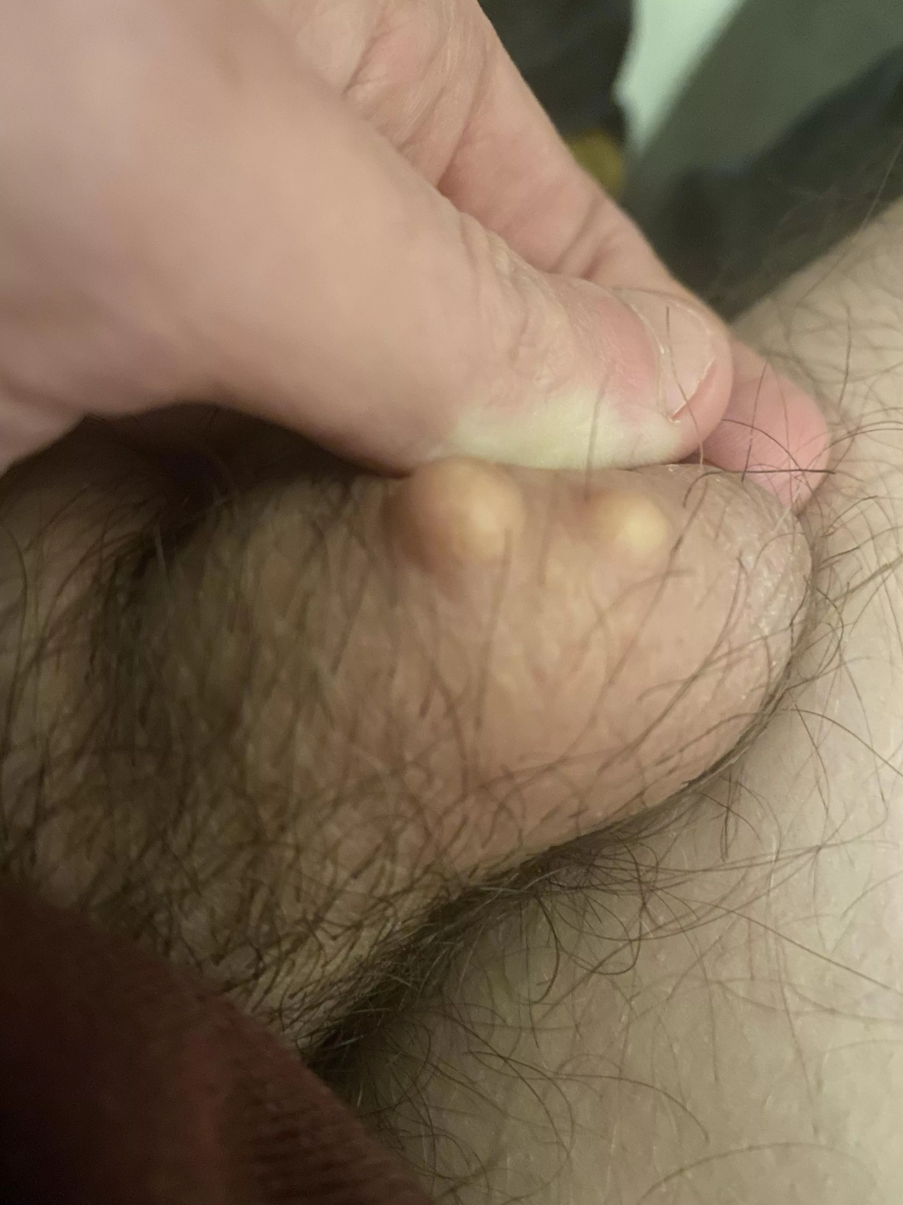 Went to the doctor as recommended by everyone in this post. Some people wanted an update so for anyone wondering, they are just cysts and harmless. Check your balls guys.