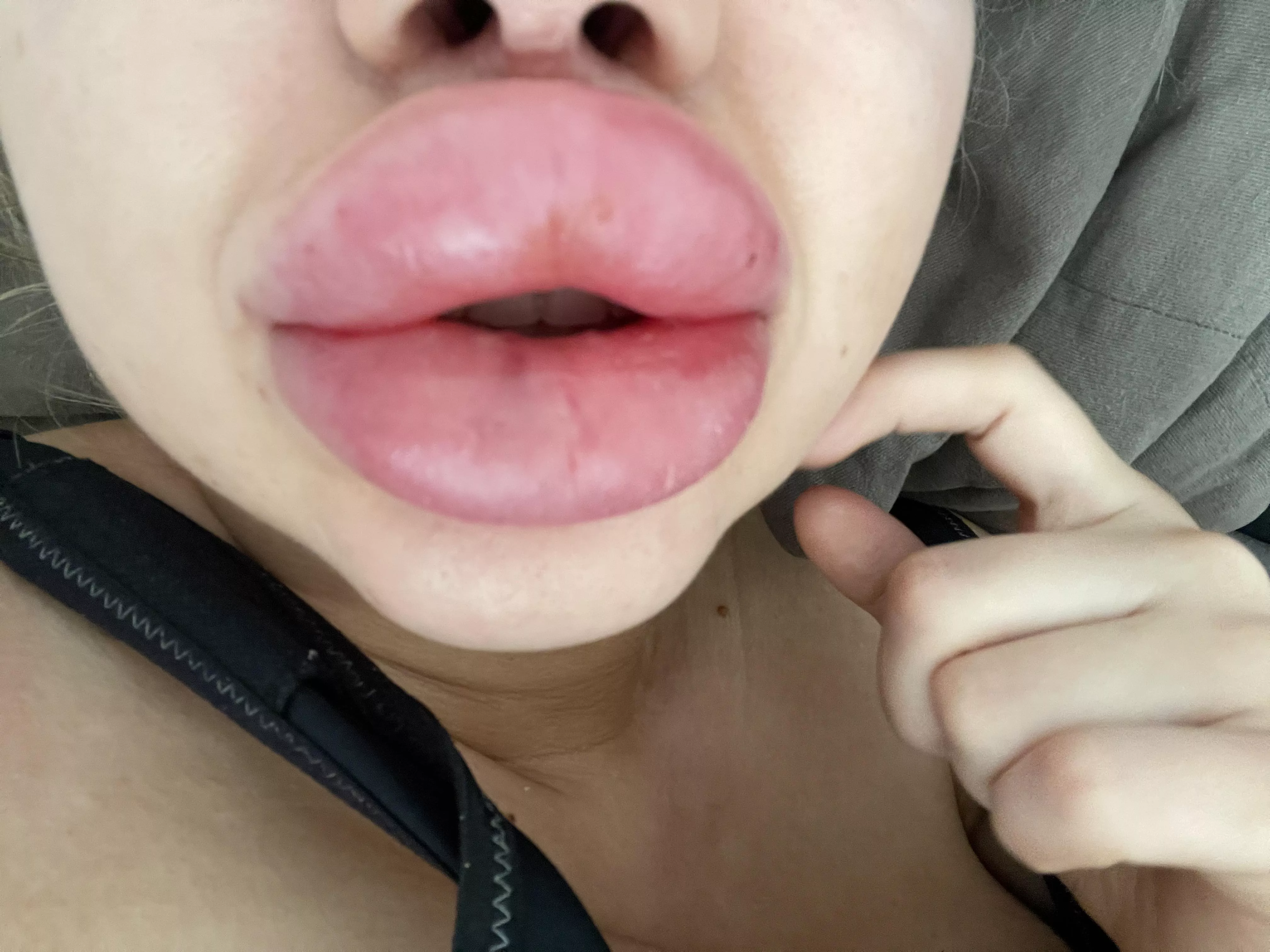 What do you think about my Bimbolips (two days after injection)