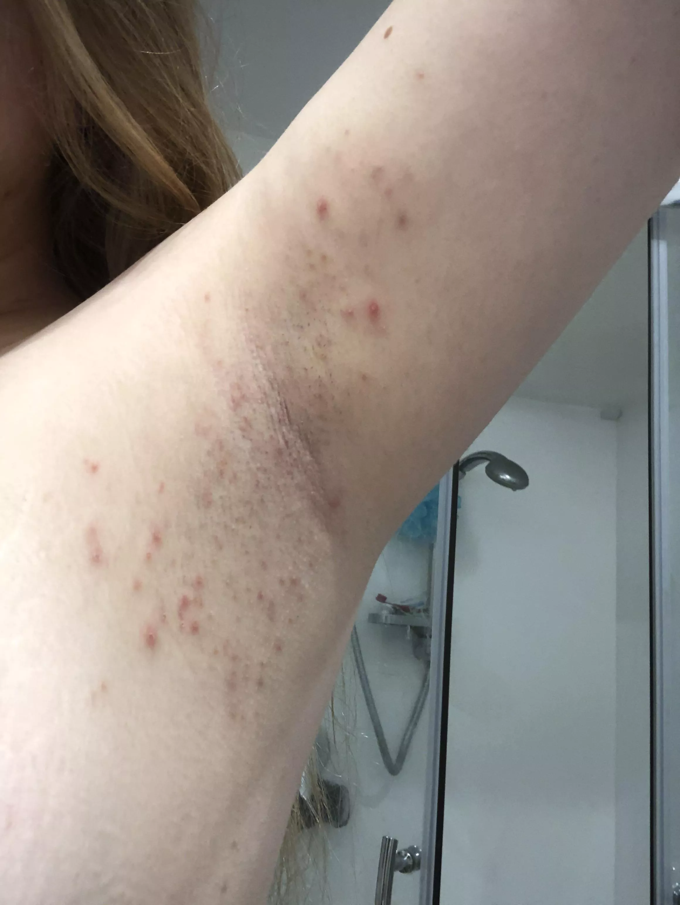 What is this? I keep getting reoccurring pimples above & below my armpits. The pimples themselves are sore, usually whiteheads but sometimes thereâ€™s deep larger ones too, it tends to last 2-3 weeks at a time & I donâ€™t get pimples anywhere els