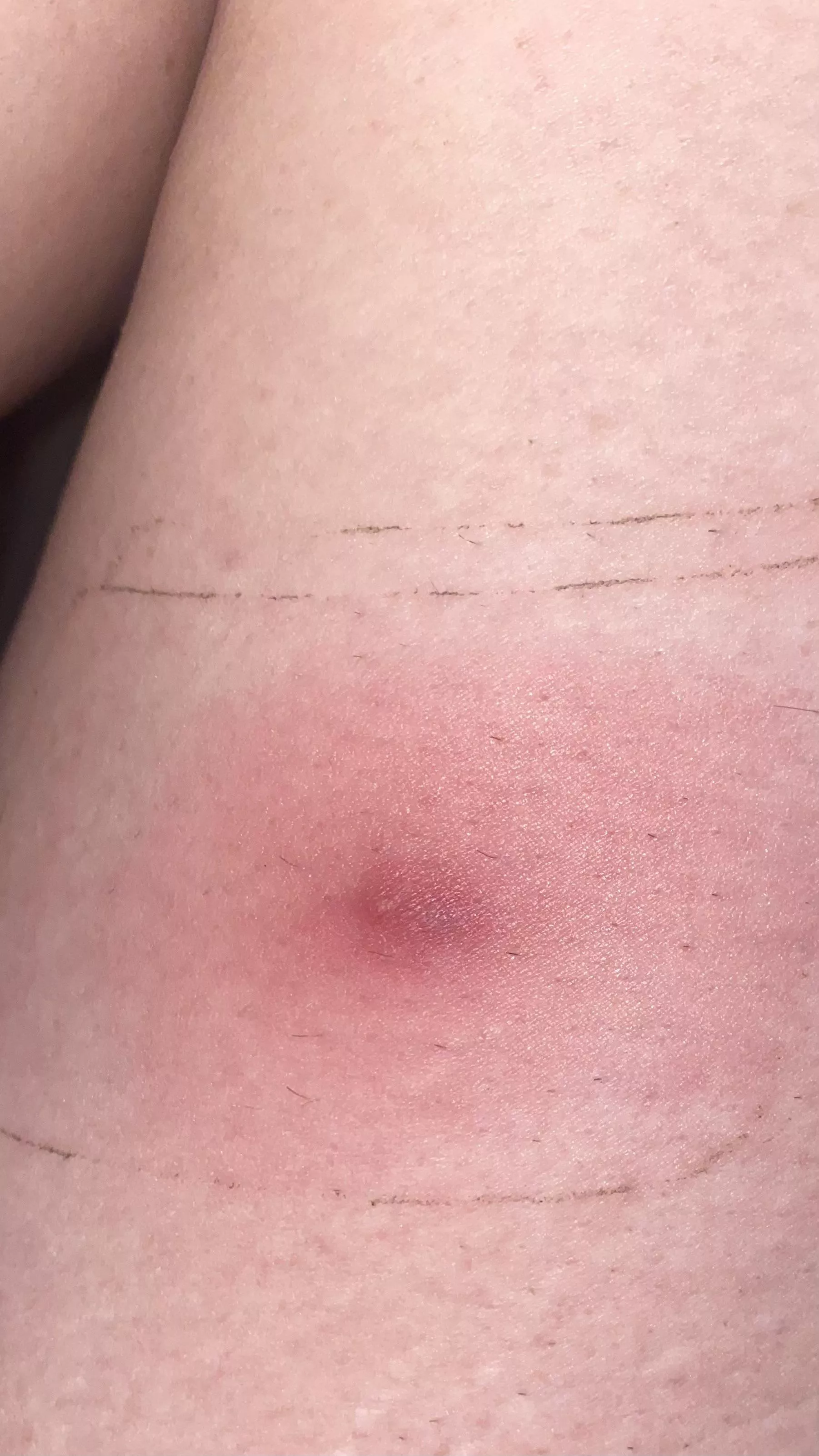 What is this? I originally thought it was a mosquito bite (itchy af) but then it started to get really red/purple?, sore, and hurt to put weight on the leg.. hot compresses donâ€™t seem to be helping. When I put a bandaid and polysporin on it seems to oo