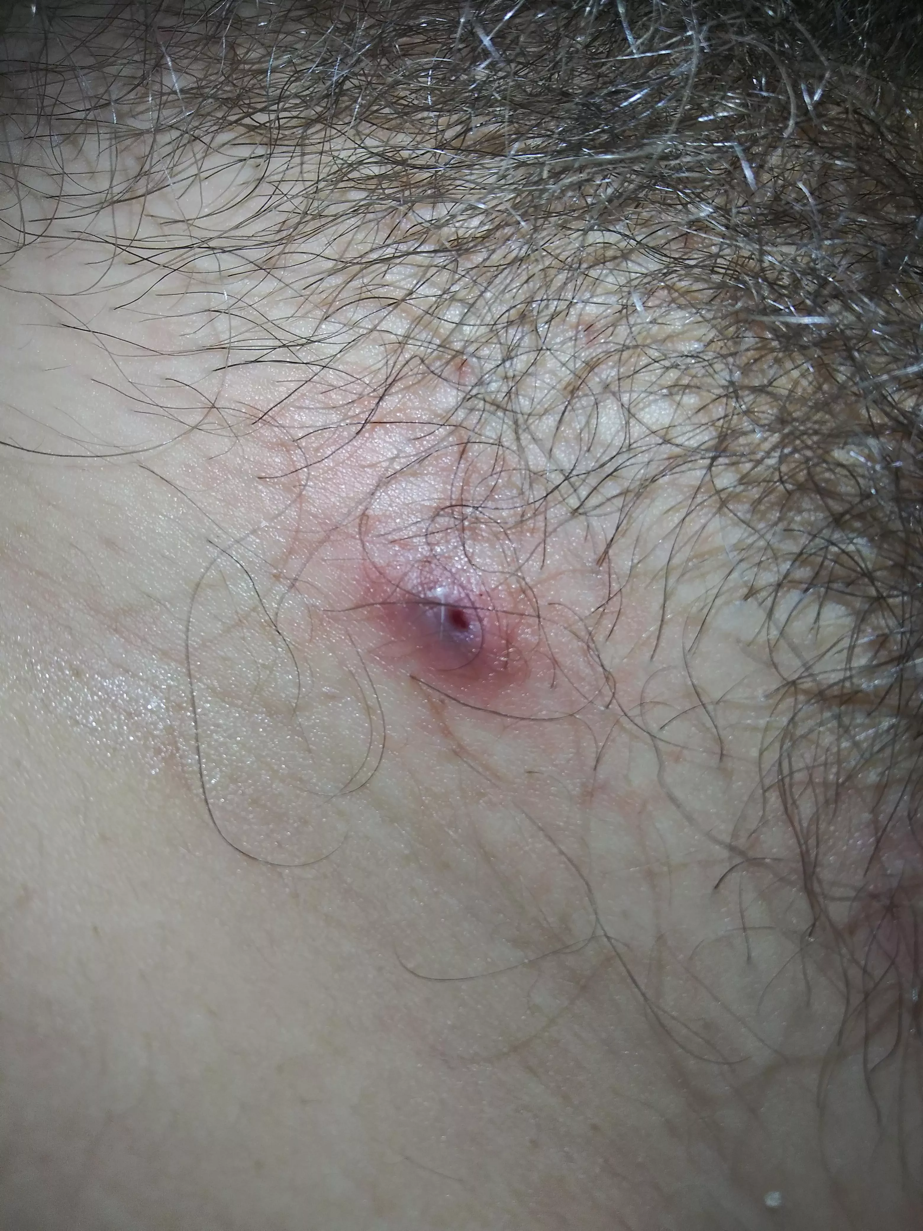 what is this on my pubic area bloody pus came out of it. it was pretty hard the past couple days but today i barely touched it and it just popped