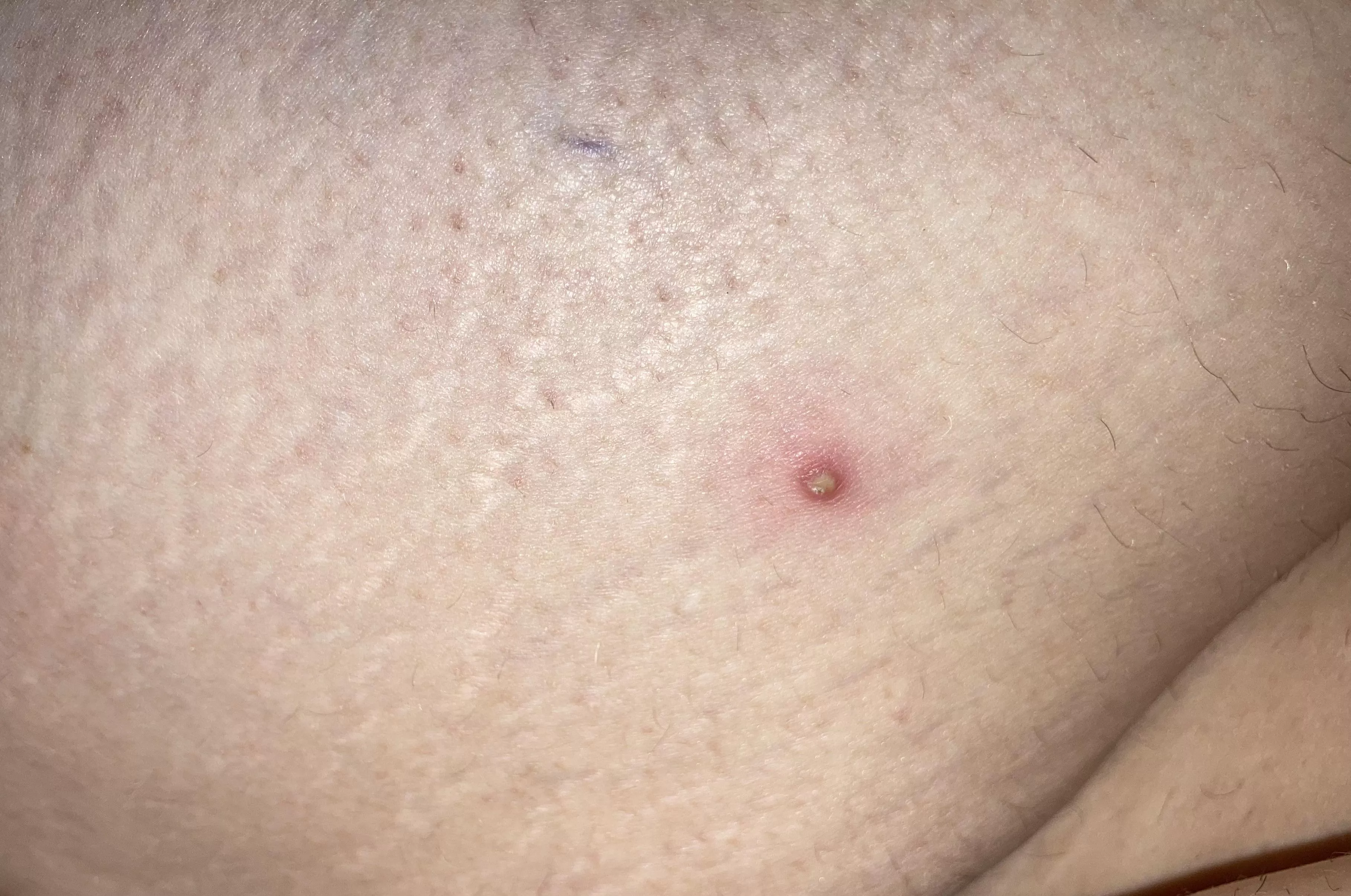 Whitehead that popped up over night on the back of my upper thigh.