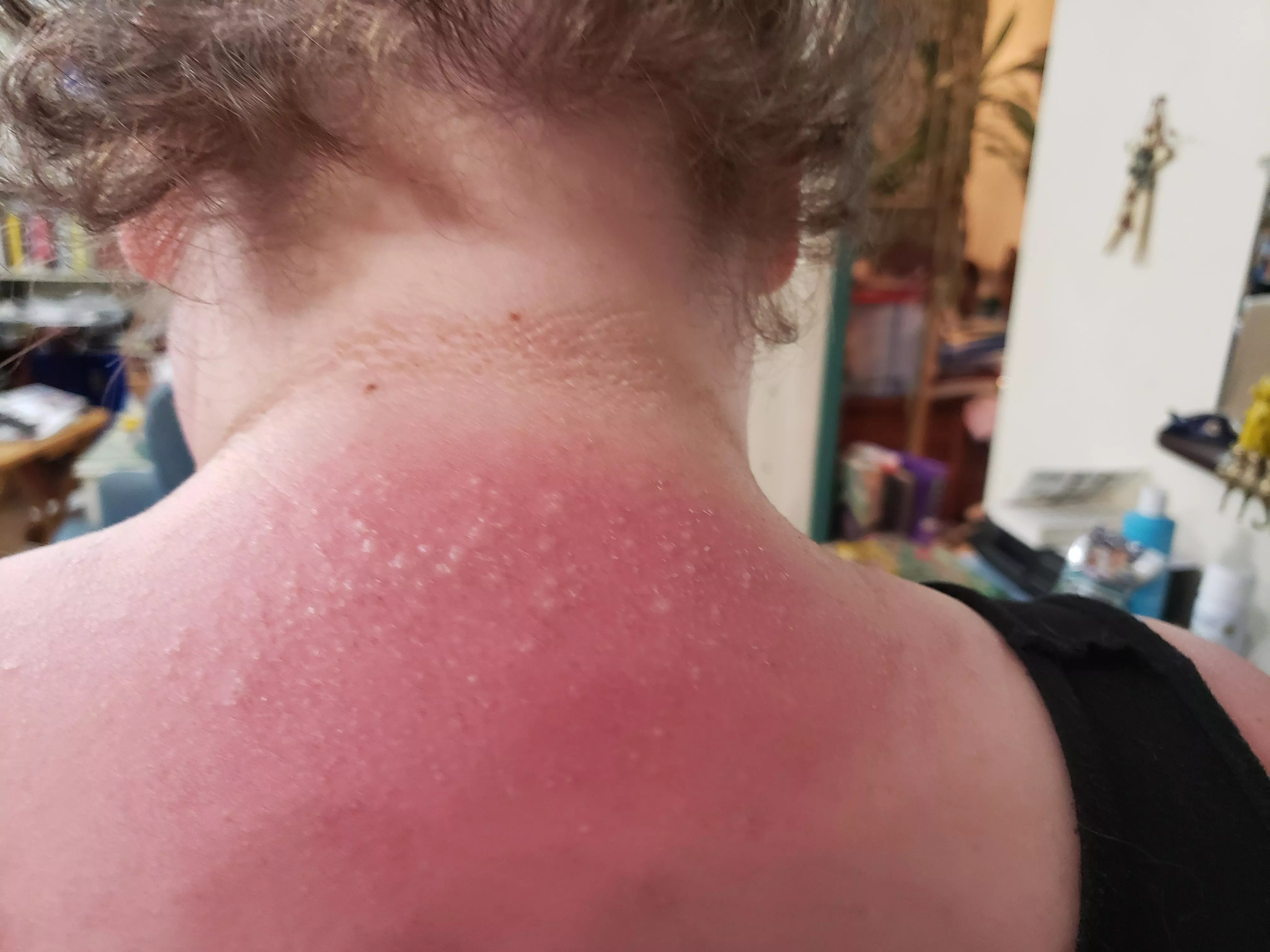 y'all accept sunburn blisters?