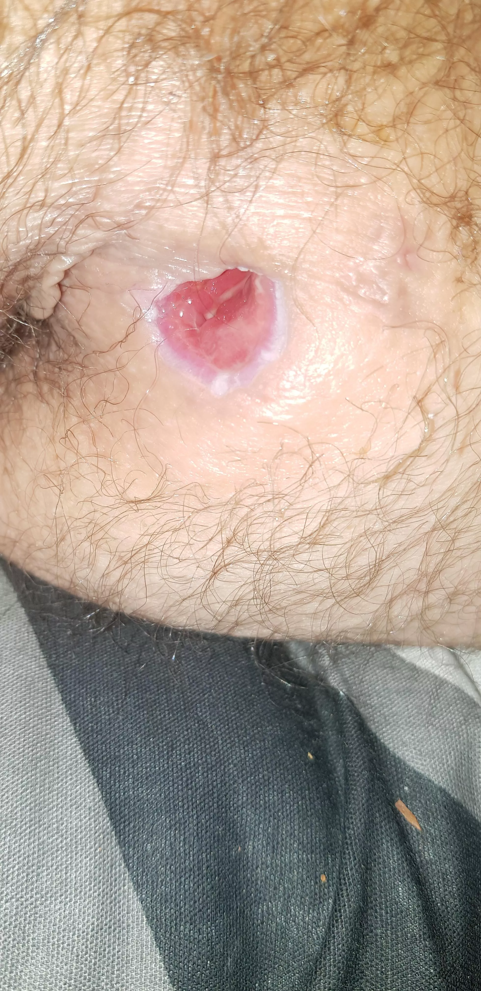 2 weel after surgery on my abscess and its healing great (thats wot im told)