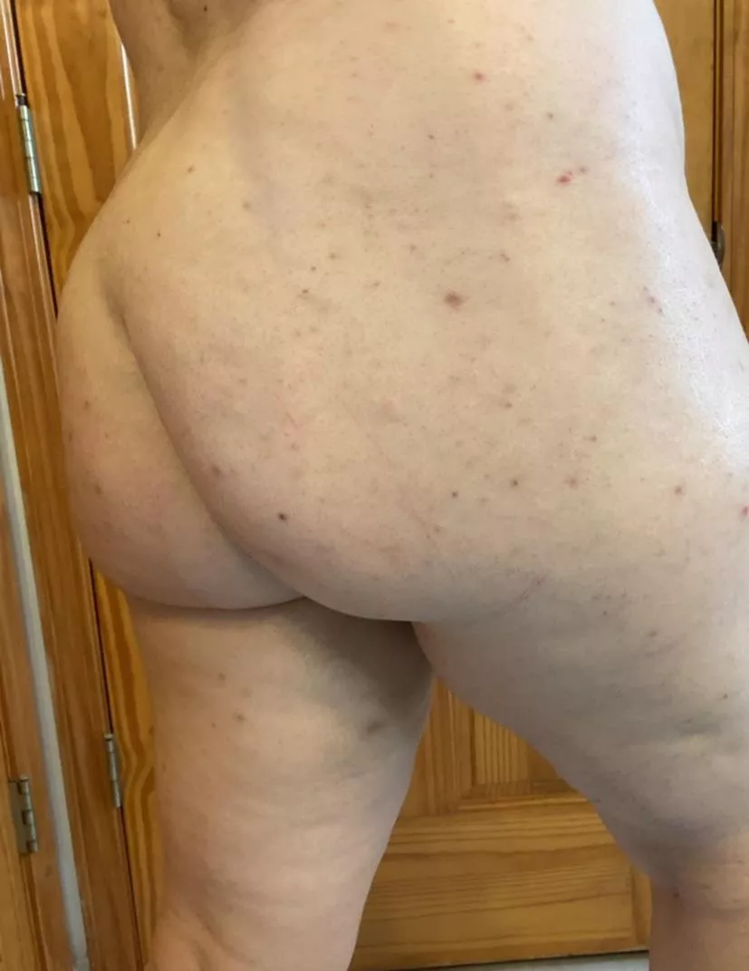 (28F 230lbs 5â€™5) Iâ€™m here to represent my people with spots all over our butts. Trying to overcome my hyperpigmentation problem!