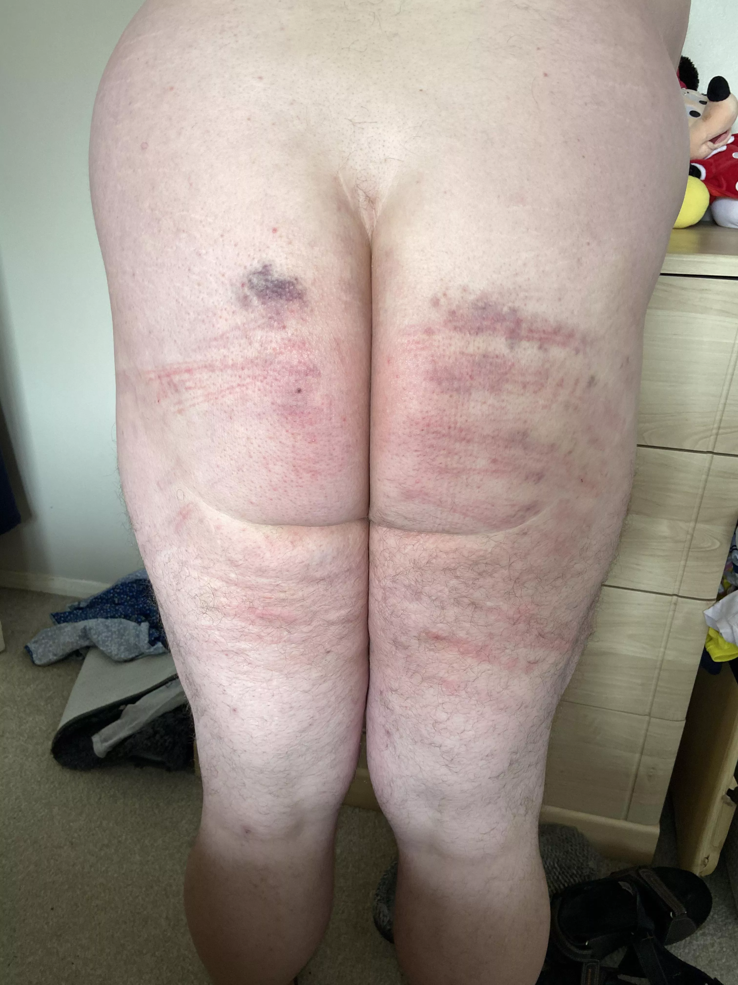 A day after my caning. Bruises coming out now.