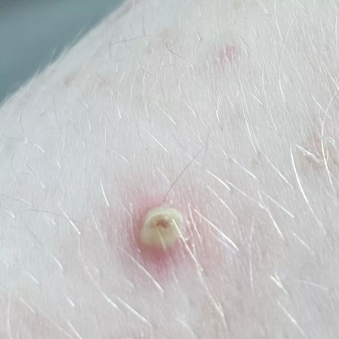 angry keratosis pilaris after popping a day before (sorry i donâ€™t have a video, but you know itâ€™s a good one when itâ€™s yellow lol, had to share)