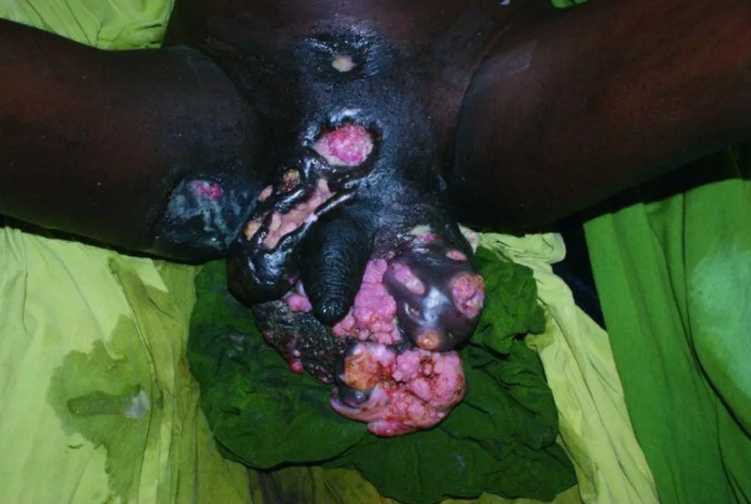 Cyst on AIDS patient