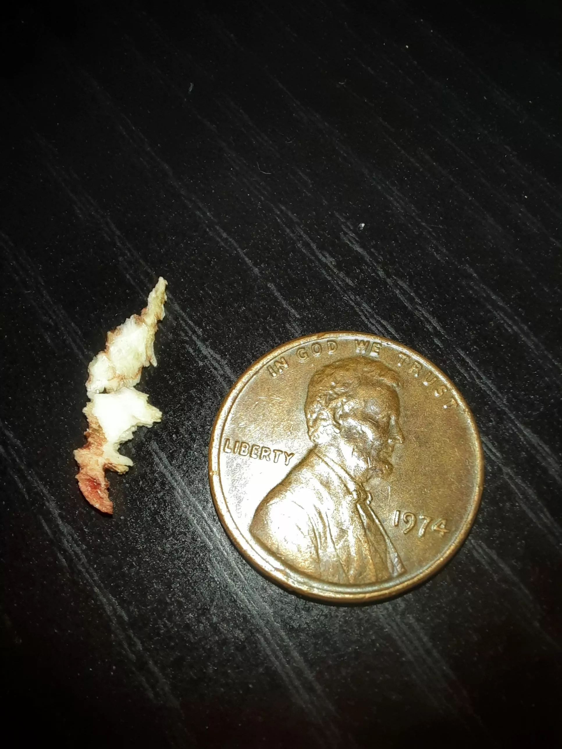 Dental sequestrum I pulled out 2.5 months post-op from infected wisdom tooth extraction site