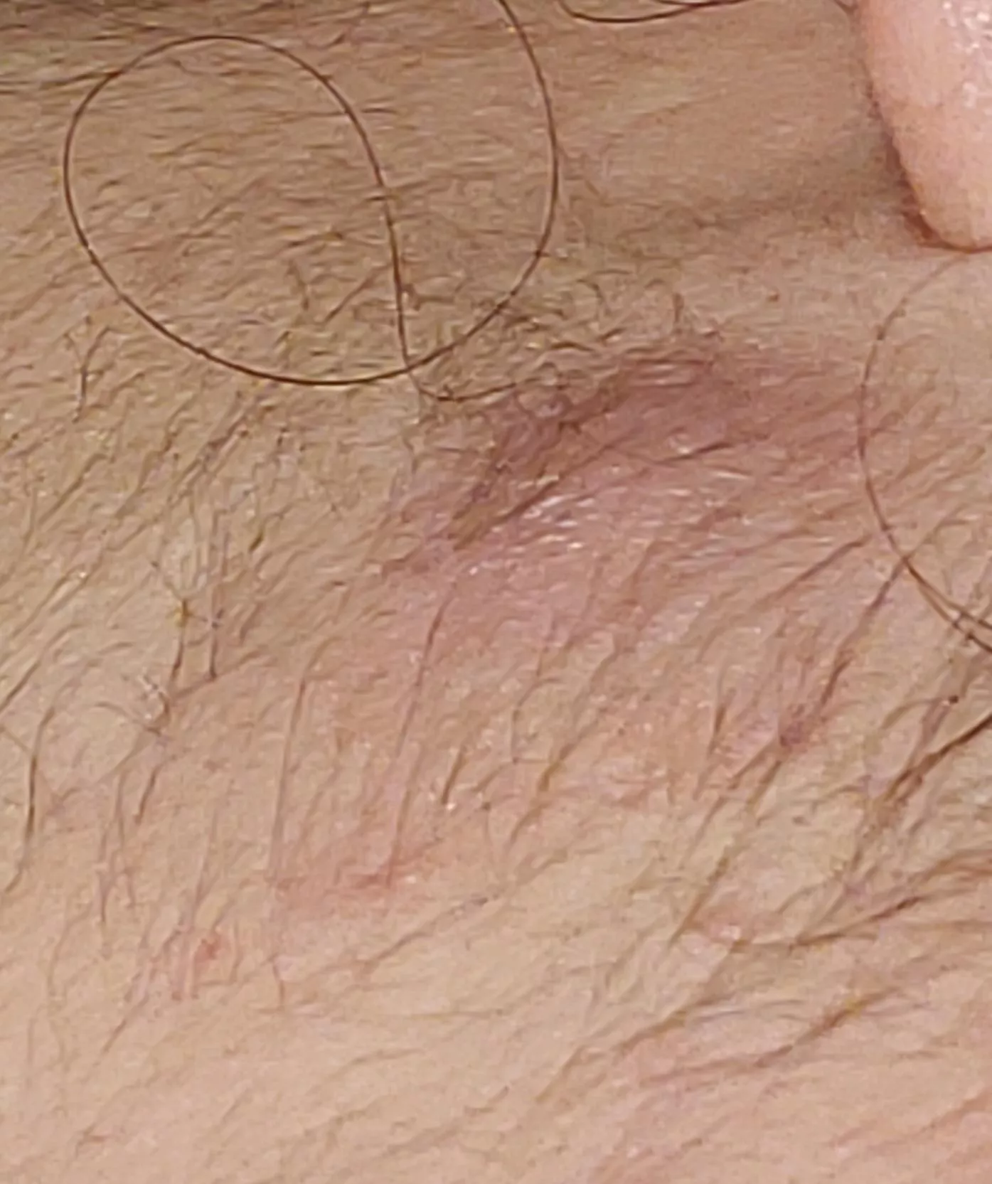 Does this look like a cyst or boil? Getting it checked out hopefully next week by a doctor. Can't seem to find a head on it but it's swollen. Delete if not allowed.