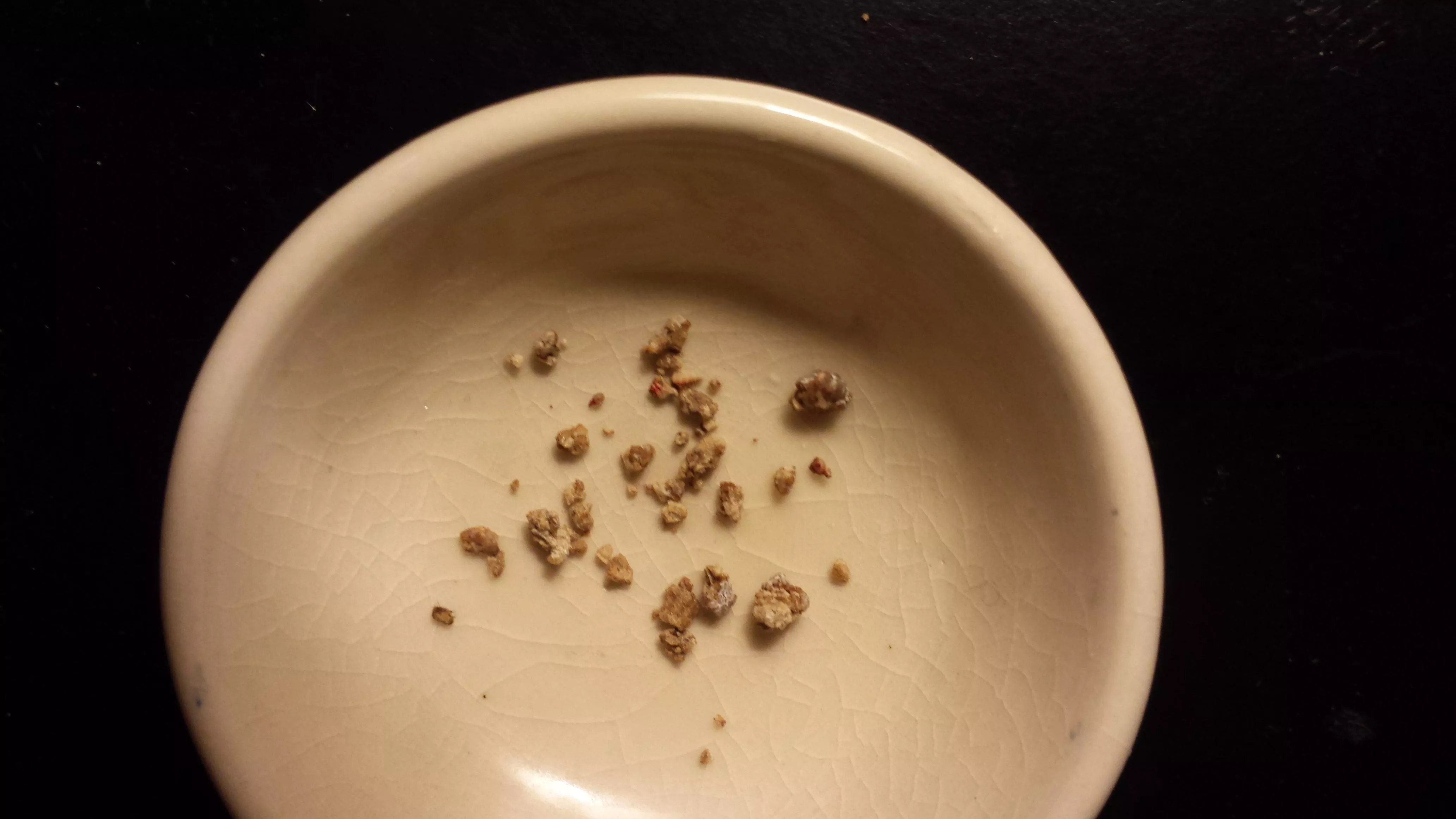 Dozens of painful kidney stones