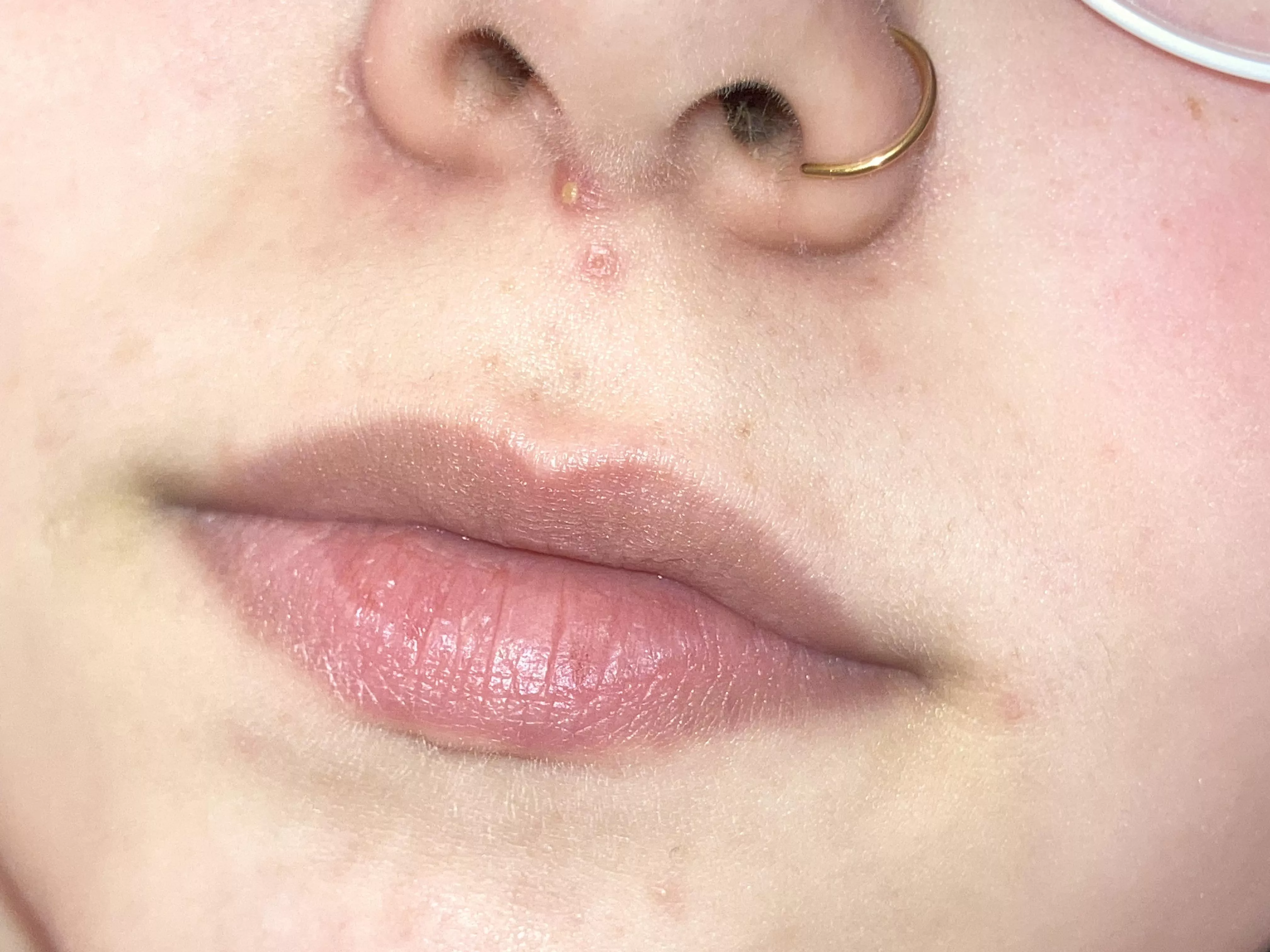 Eczema and acne after coming off the pill, forbidden pop because it hurts to sneeze/triangle of death :(