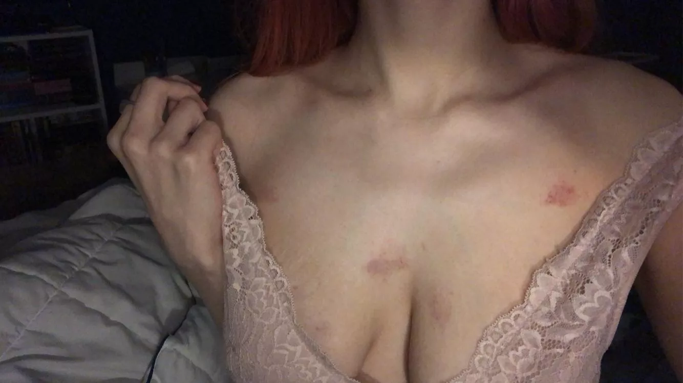 [f] lace and bite marks