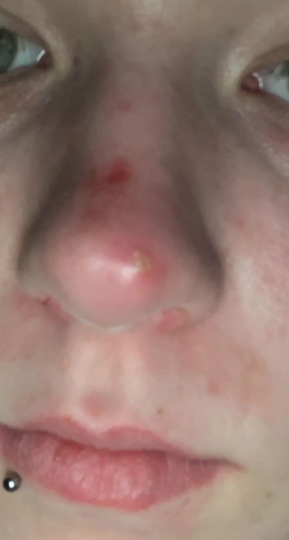 First post: had a giant red spot on the end of my nose for a week or so and while at work it started hurt whenever my mask rubbed it and then I see this beauty