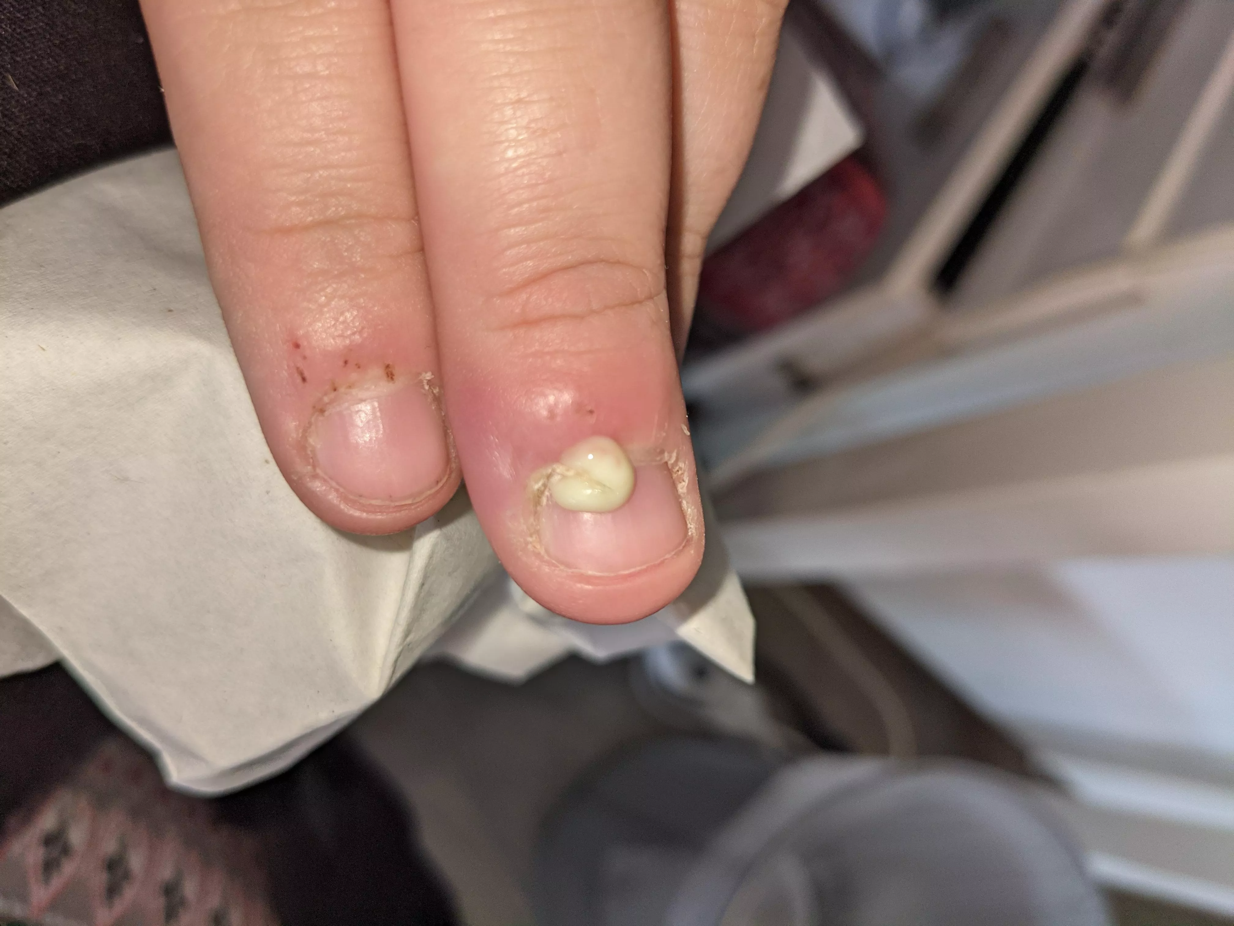 First submission! Post-pop of a cuticle infection (accidentally, would have recorded if I knew it would pop today) will provide update if more comes out later ðŸ˜‚