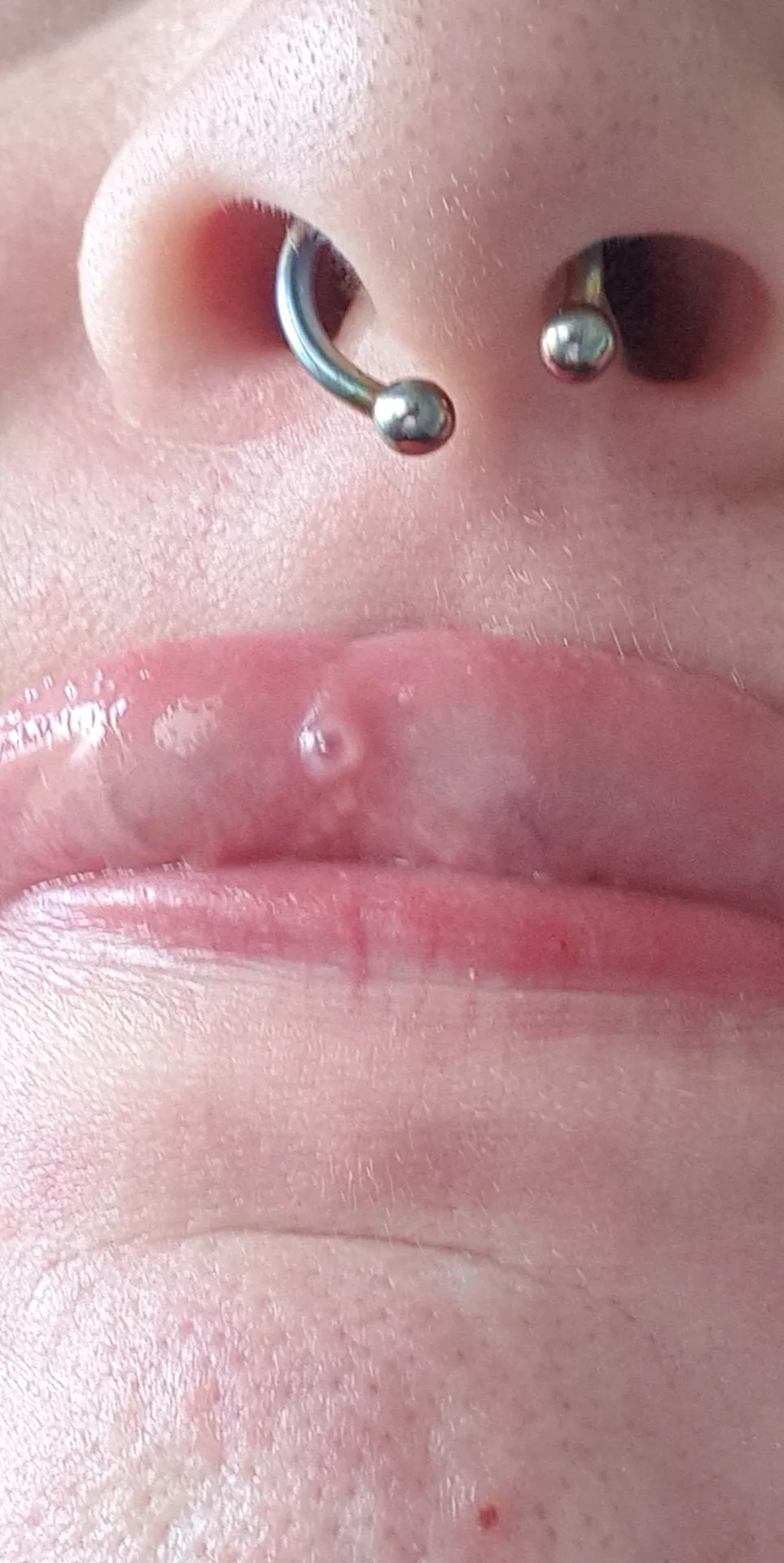 Forbidden ulcer pop... honestly I just wanted to show you guys how cool it looked!! And no its not just a spit bubble