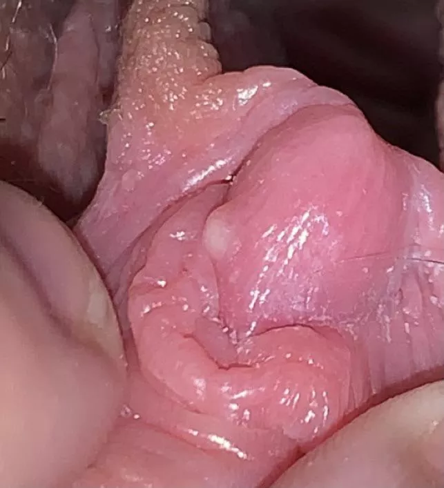 forbidden whitehead, LITERALLY on my clit. not painful or bothering me at all but i KNOW IT’S THERE and it’s driving me nuts