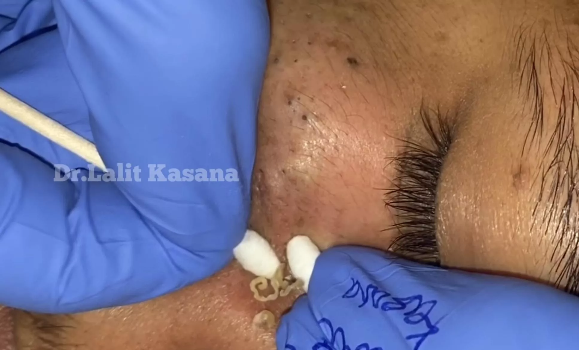 Goldmine of deep Blackheads (Dr.Lalit Kasana) It’s a repost but we’ll worth another watch! Link in comments..